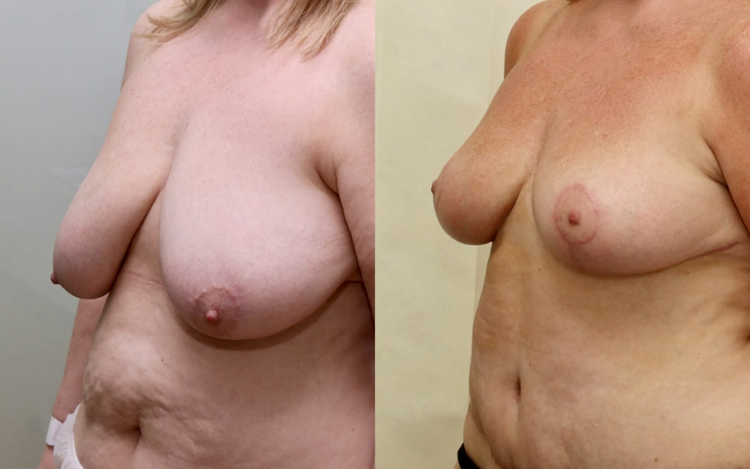 Breast reduction before and after - asymmetry