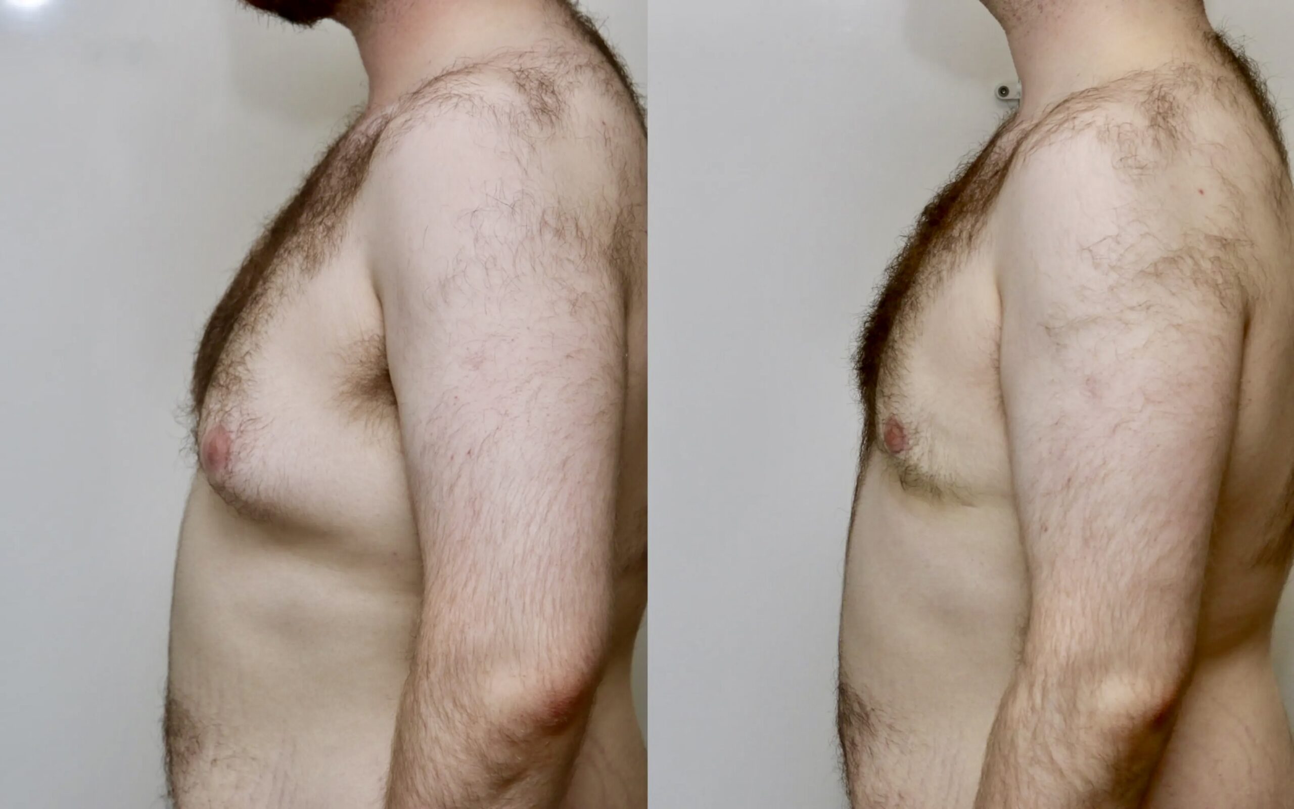 Male breast reduction before and after