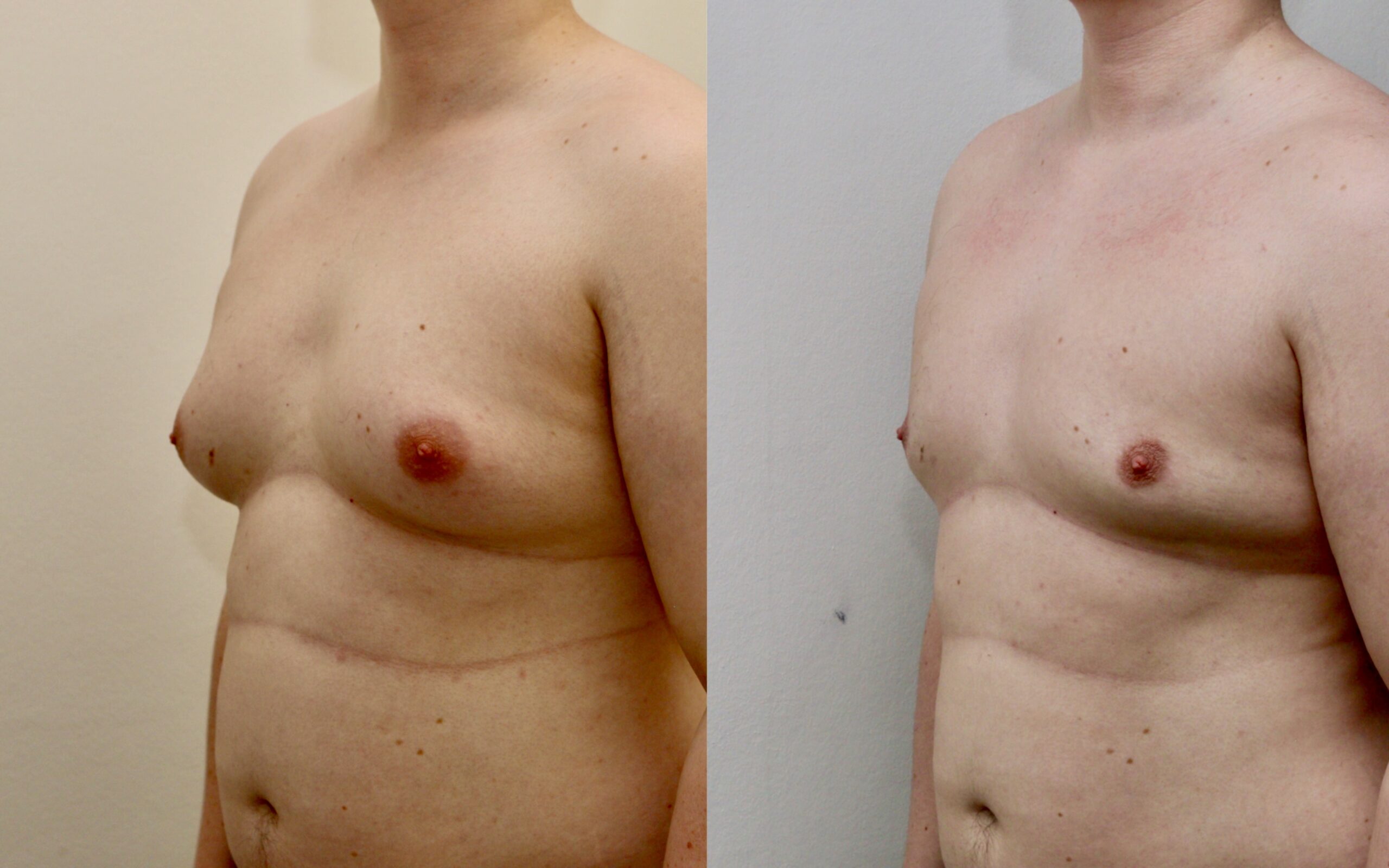 Gynaecomastia before and after