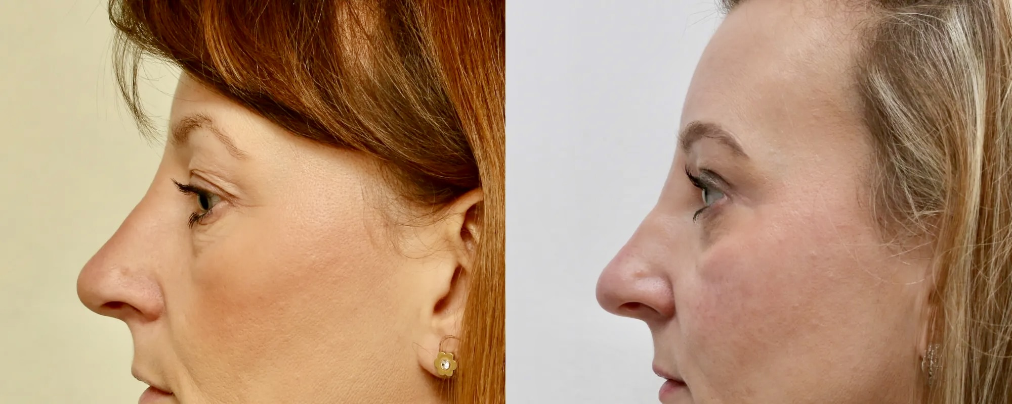 Lower and upper eyelid surgery with fat transfer