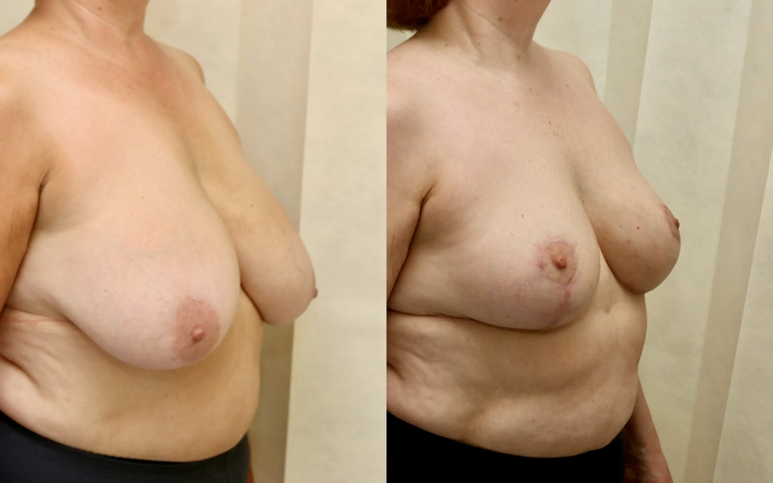 long terms after breast reduction