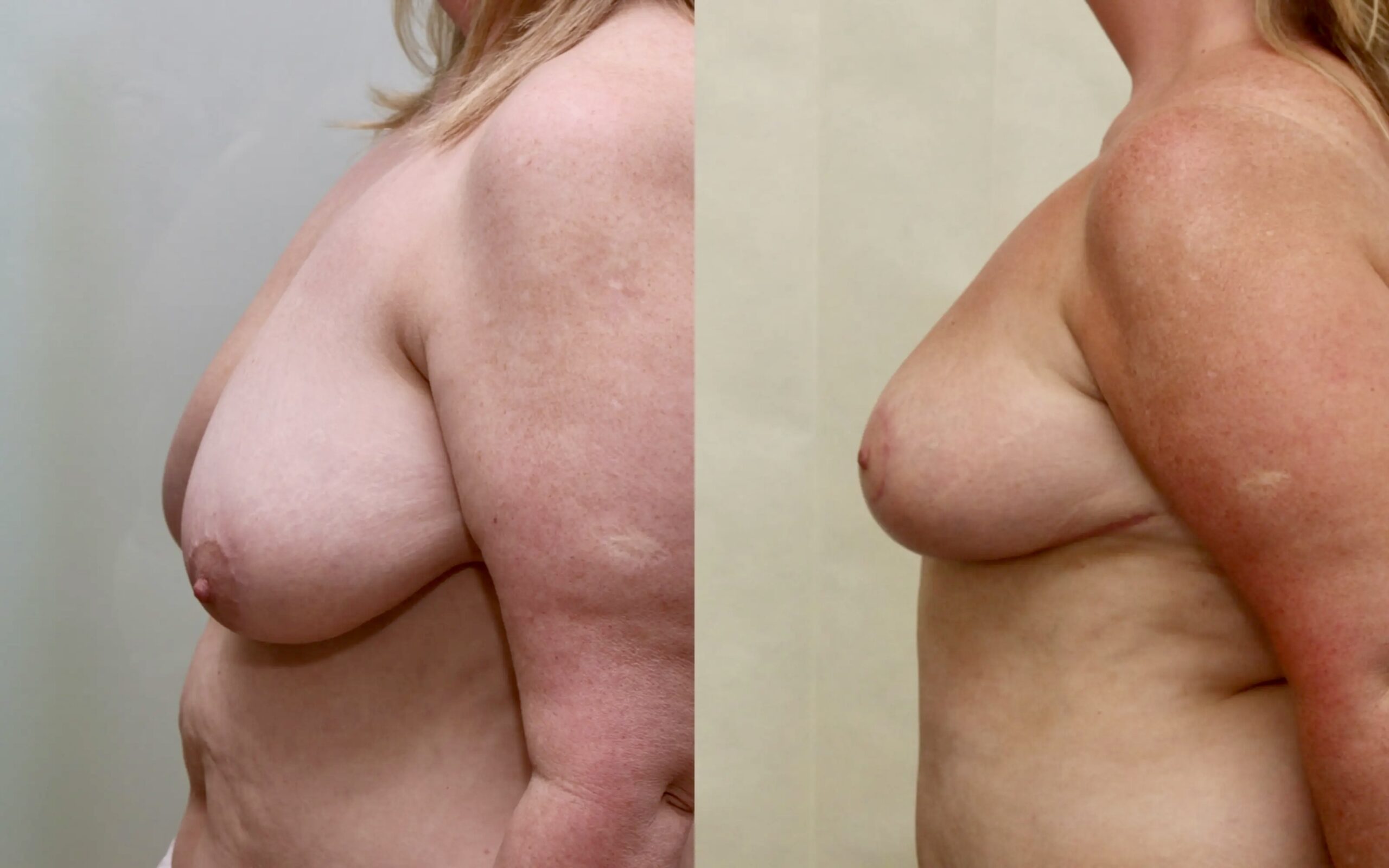 Breast lift/ reduction