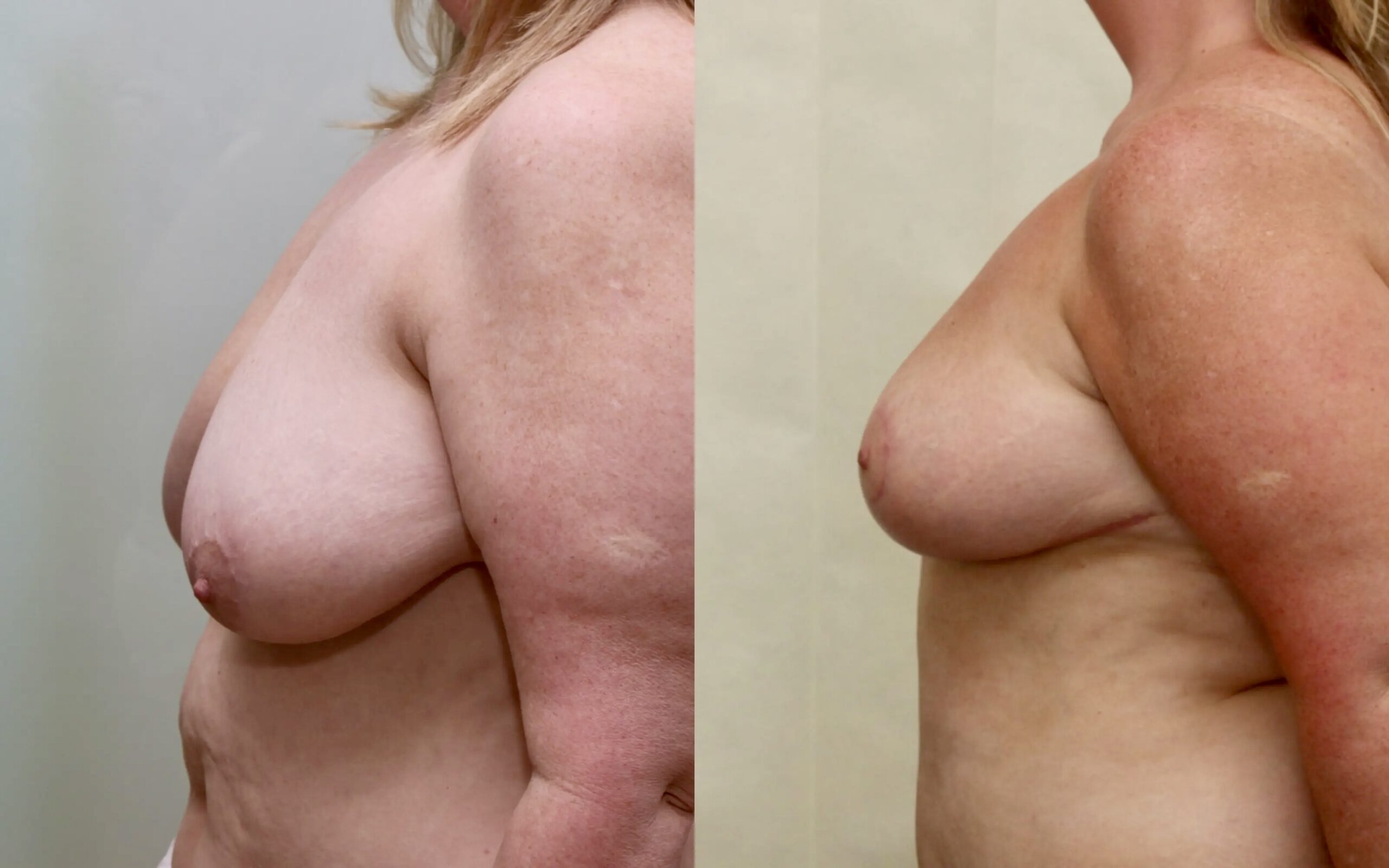 Breast reduction before and after - asymmetry