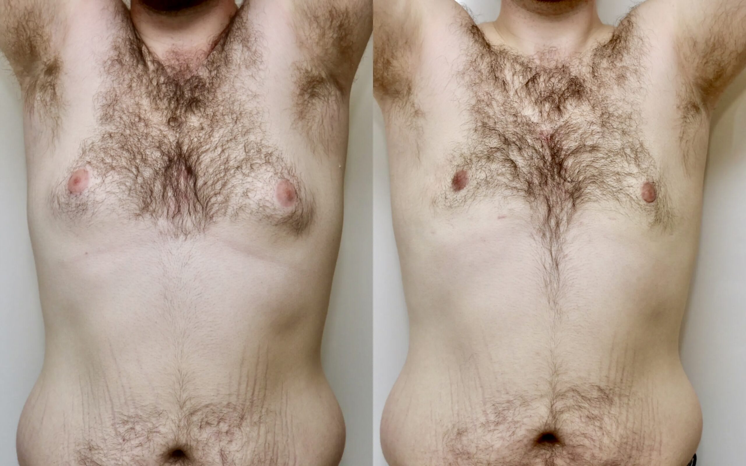 Male breast reduction before and after