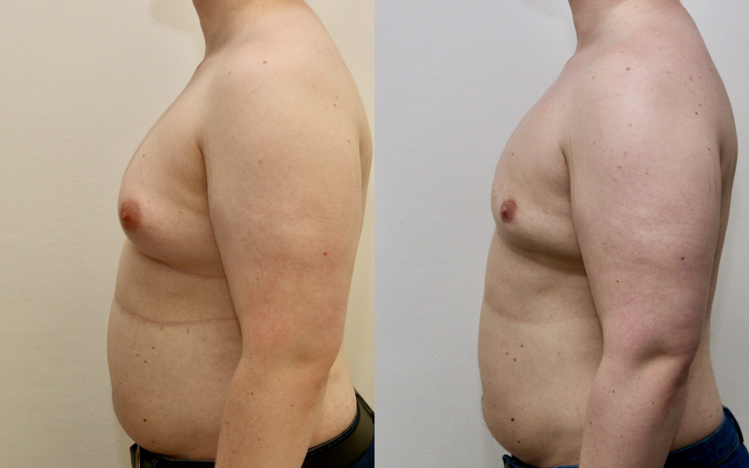 Gynaecomastia before and after