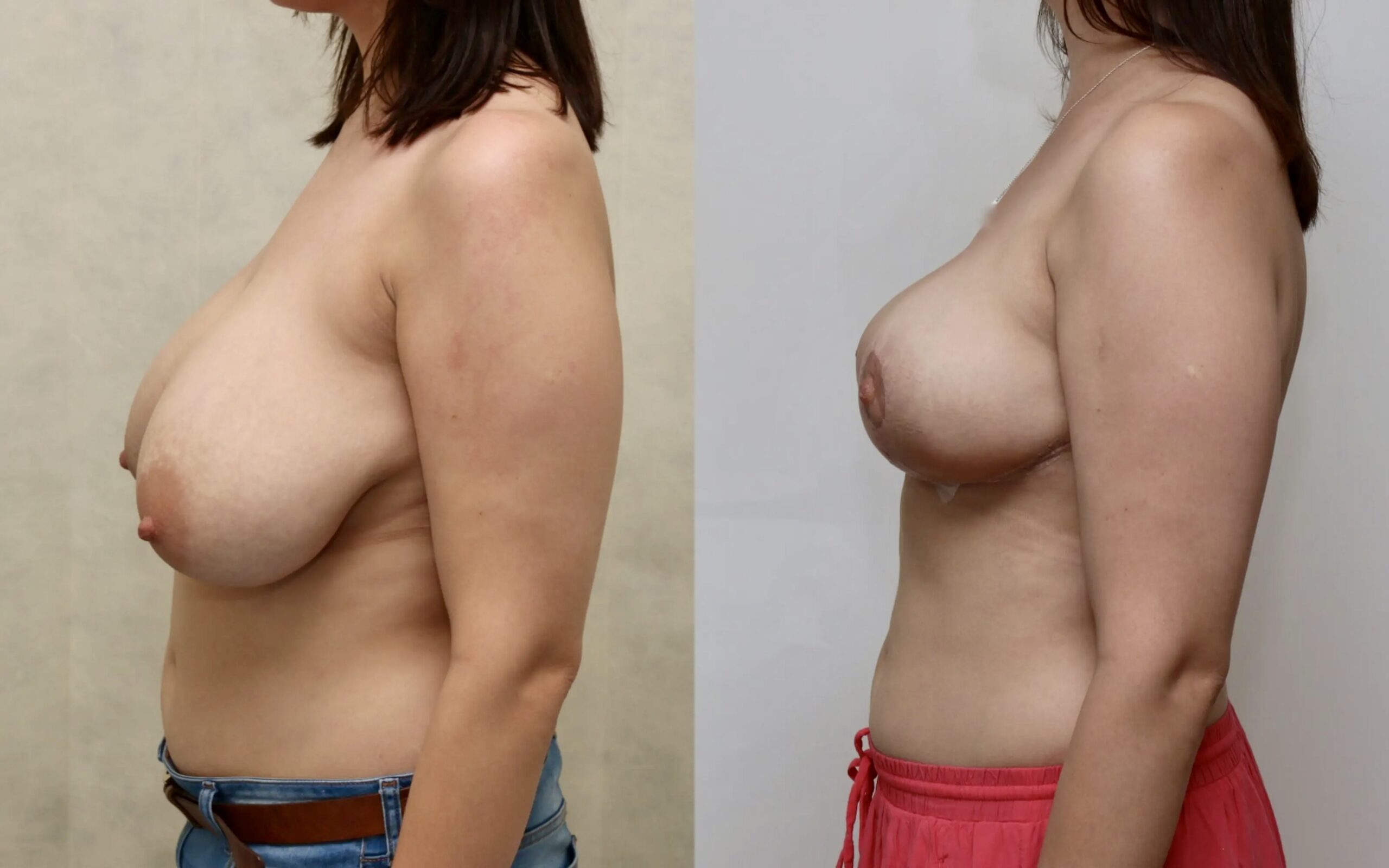 Breast reduction results at four weeks and six months