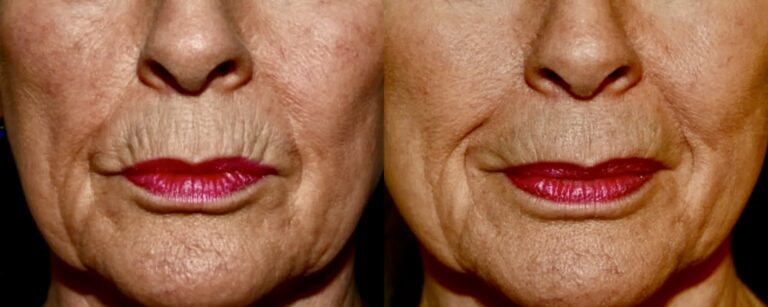 Juvéderm for upper lip creases, before and after
