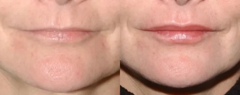 Dermal fillers: before and after