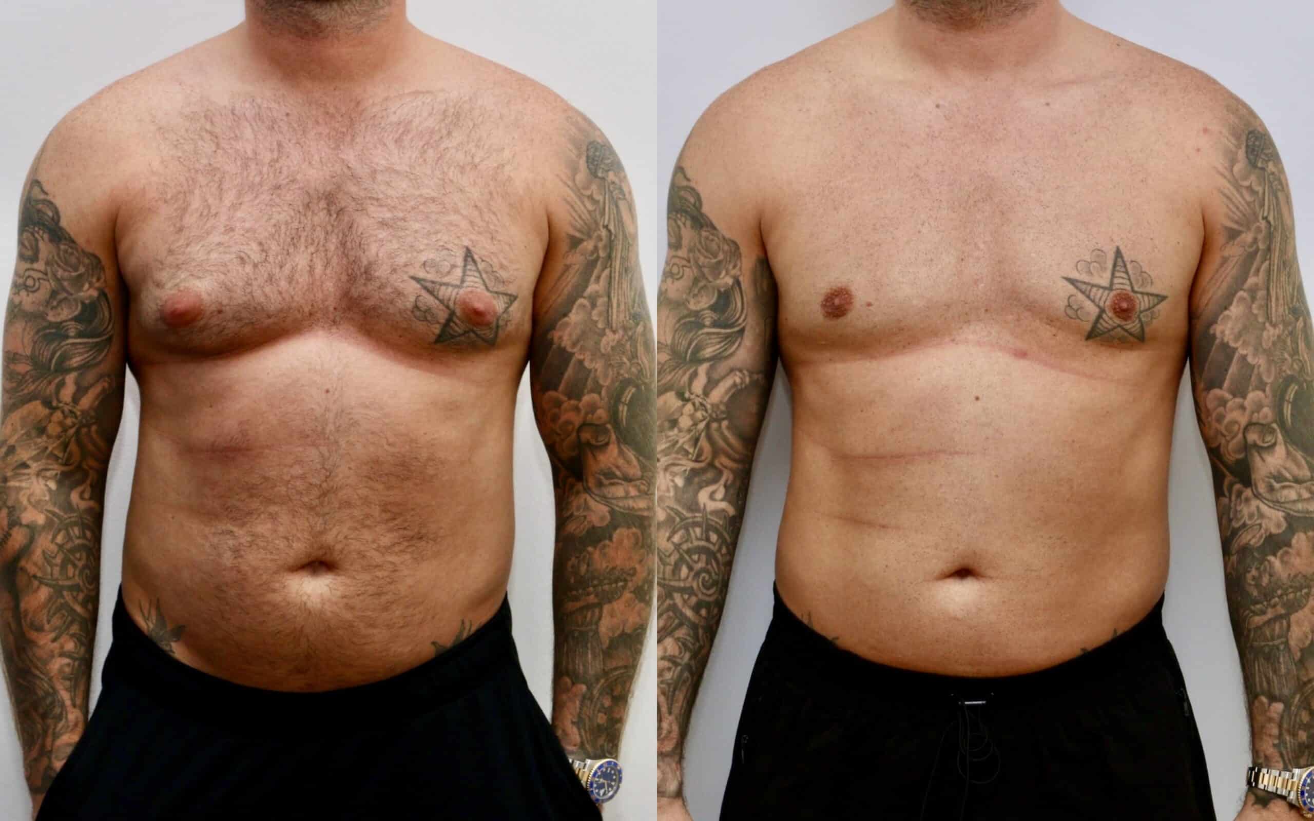 male breast reduction before and after