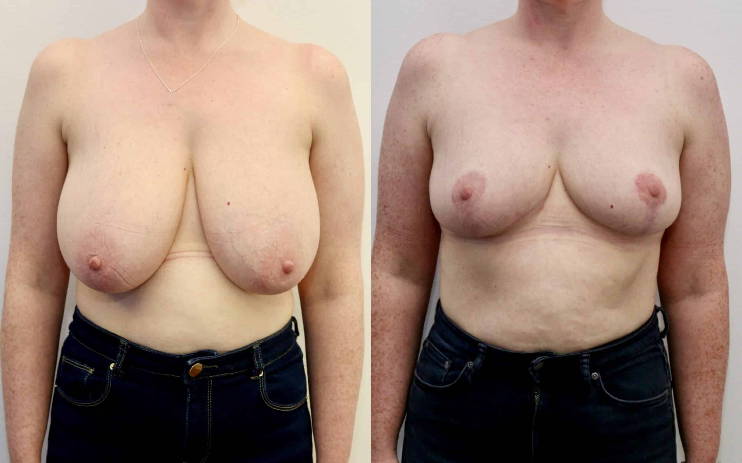 breast reduction before and after