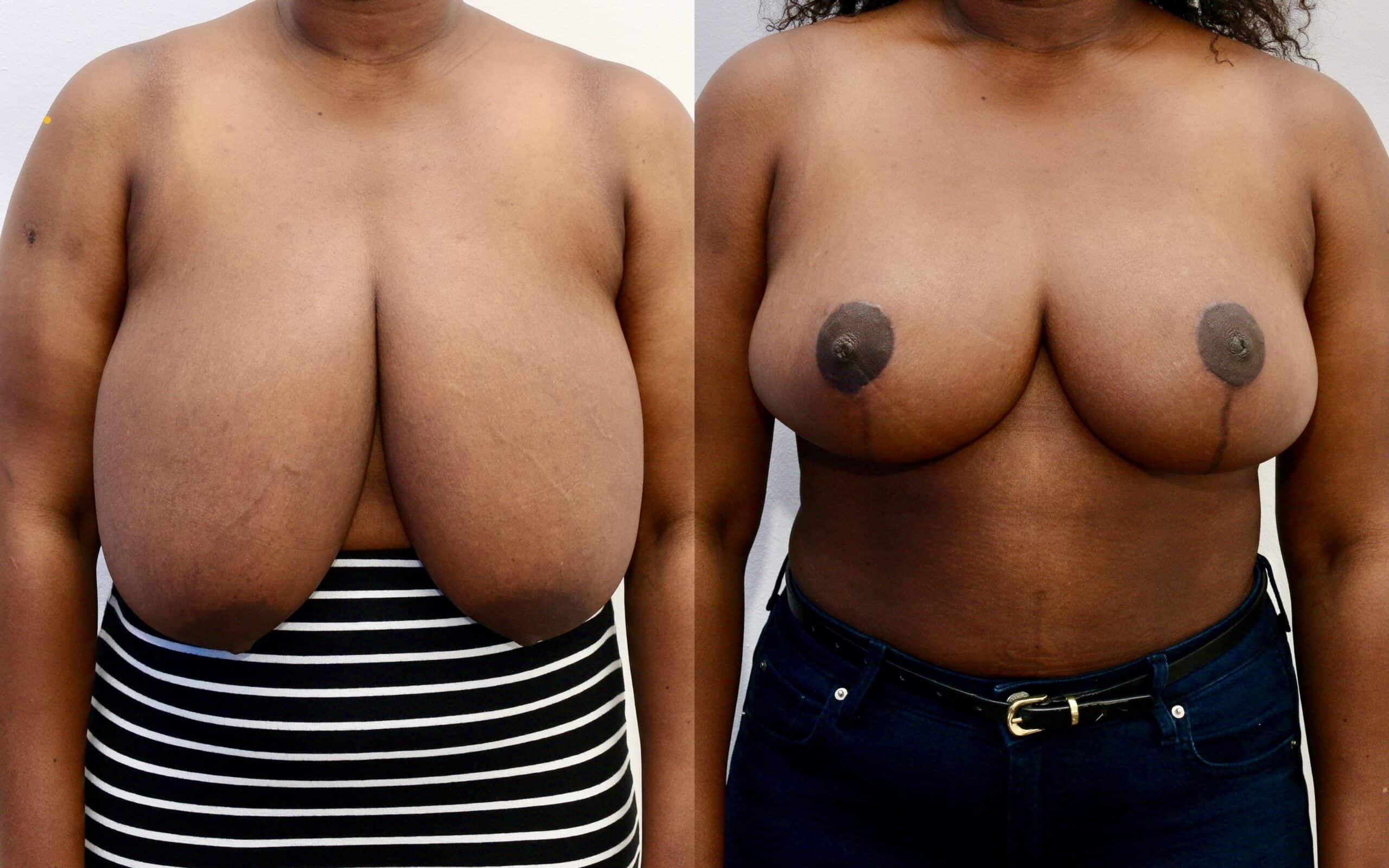 breast reduction surgery in Scotland