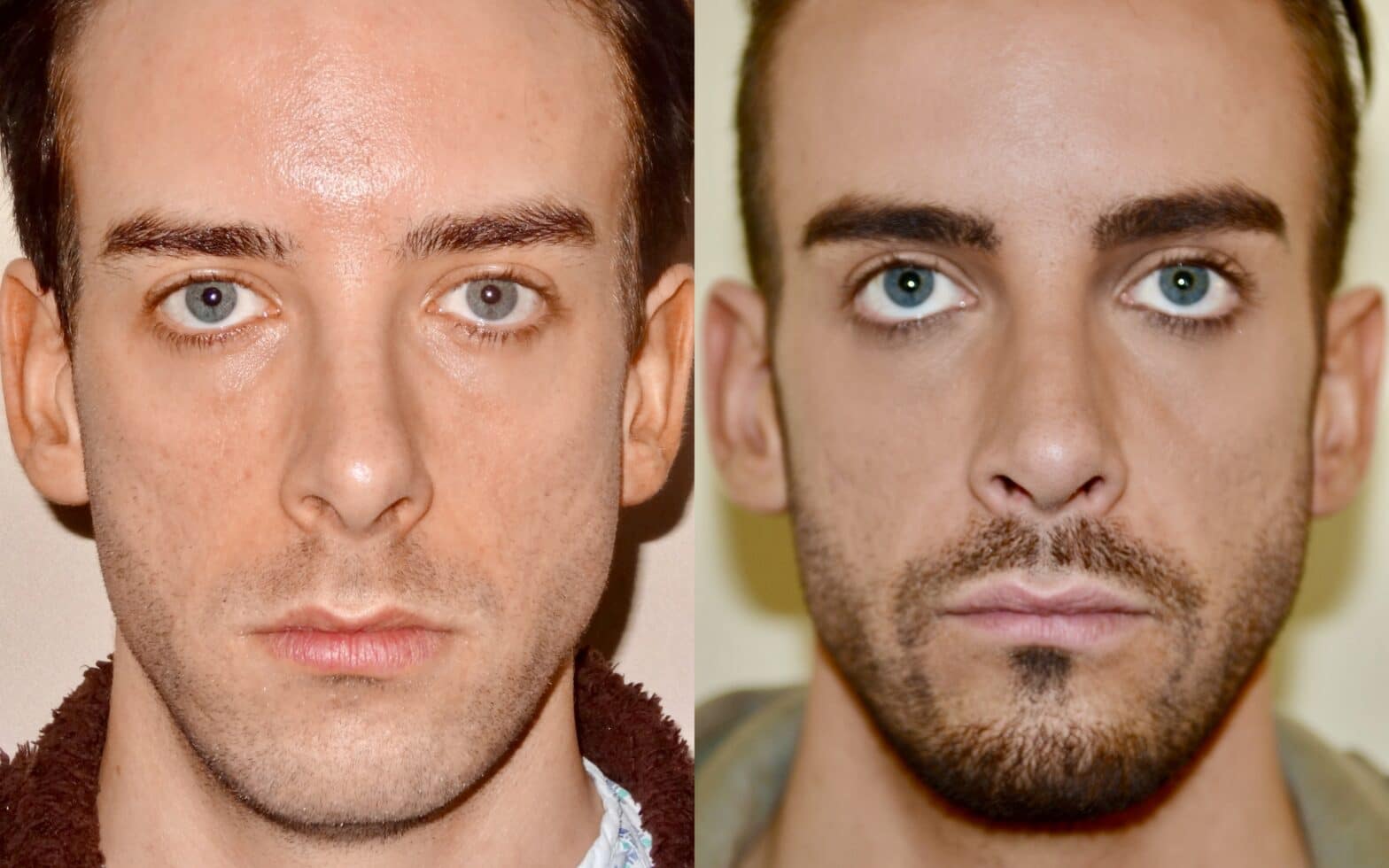 Chin Implant Before and Afters - See Results | Quaba Cosmetic Surgery