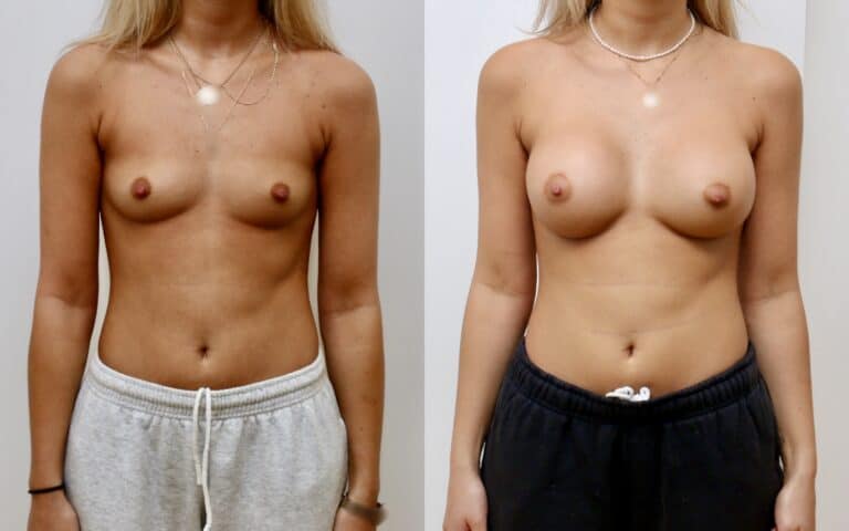Breast augmentation before and after, case 10, photo 1 of 6