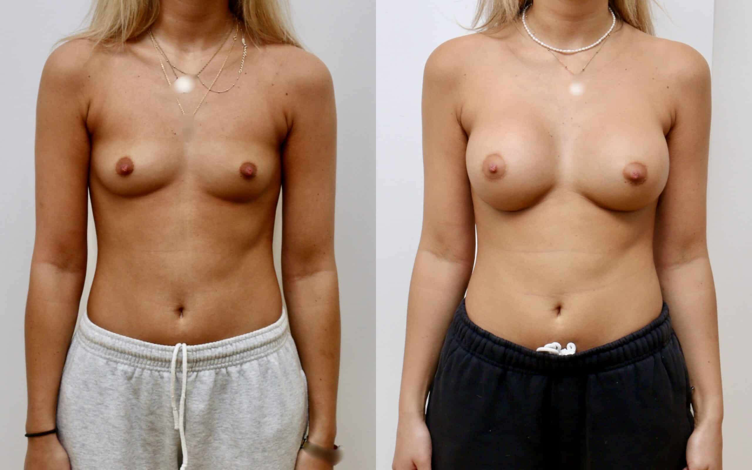 breast implants 300cc below muscle