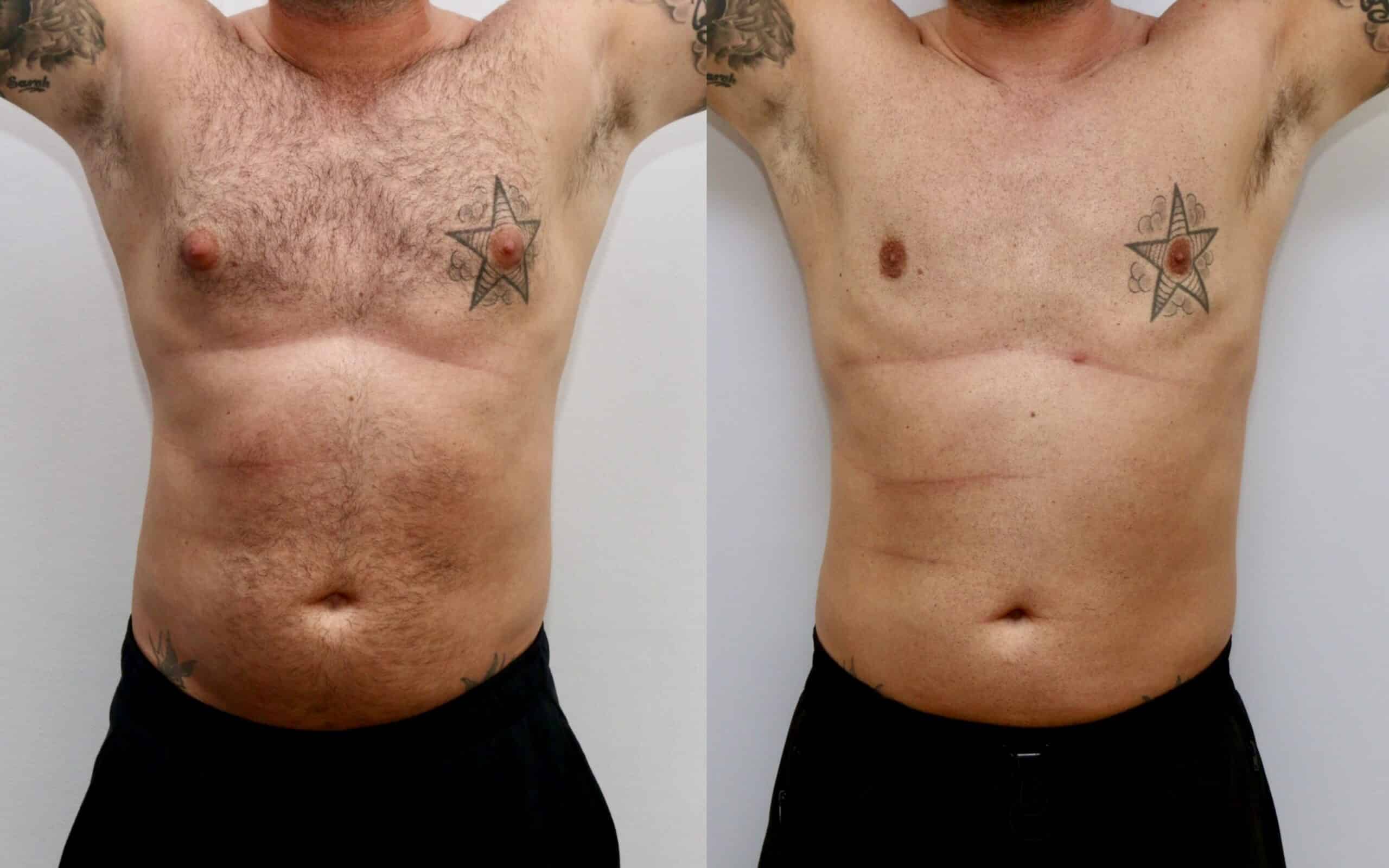 male breast reduction before and after