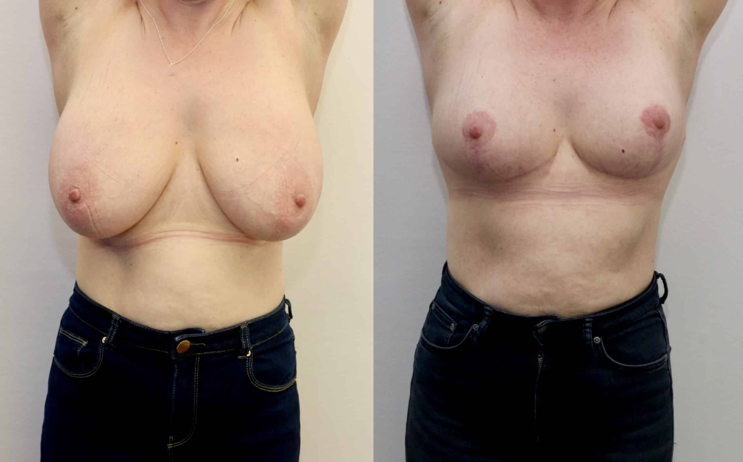 breast reduction before and after