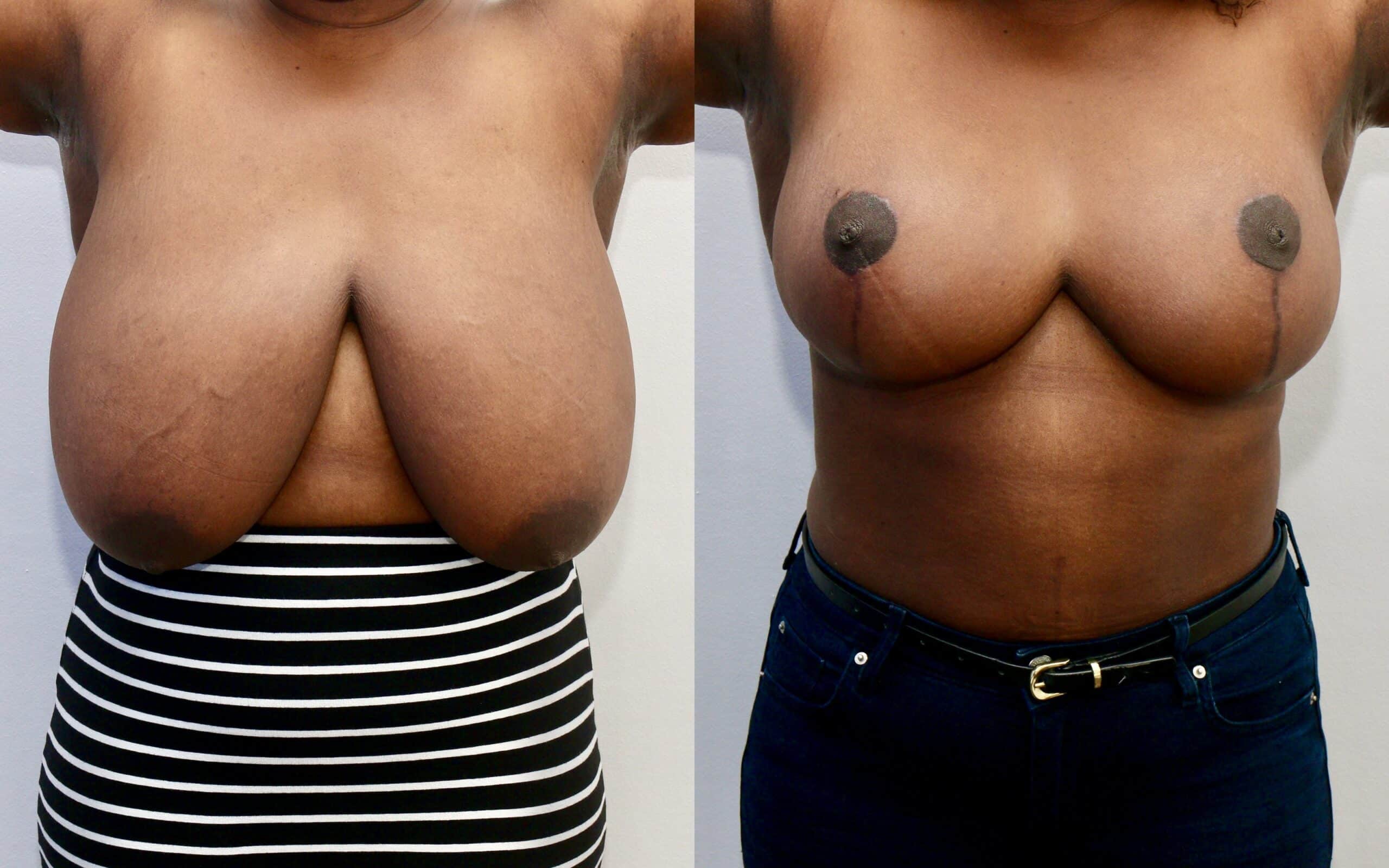 breast reduction surgery in Scotland