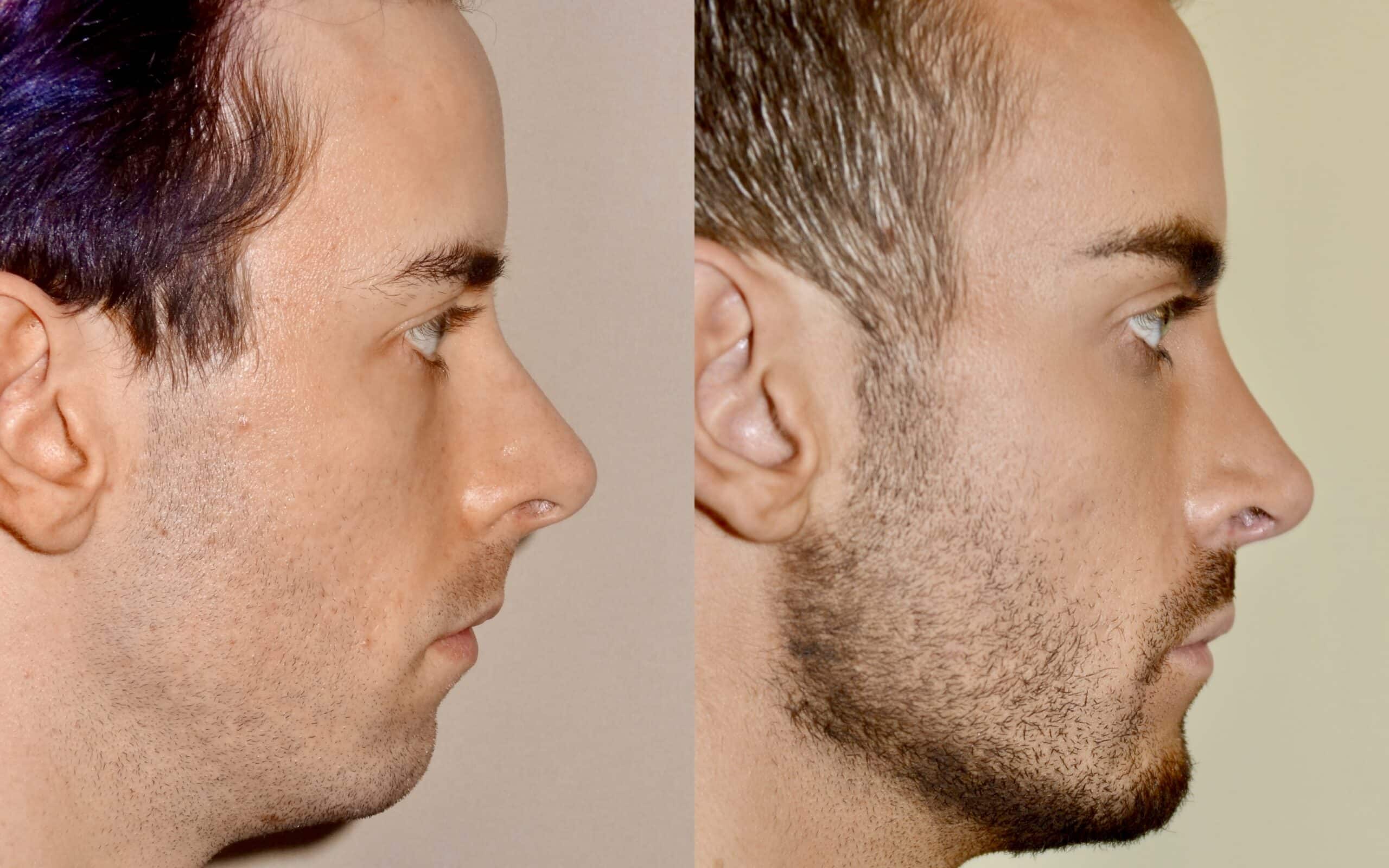 Chin implant before and after