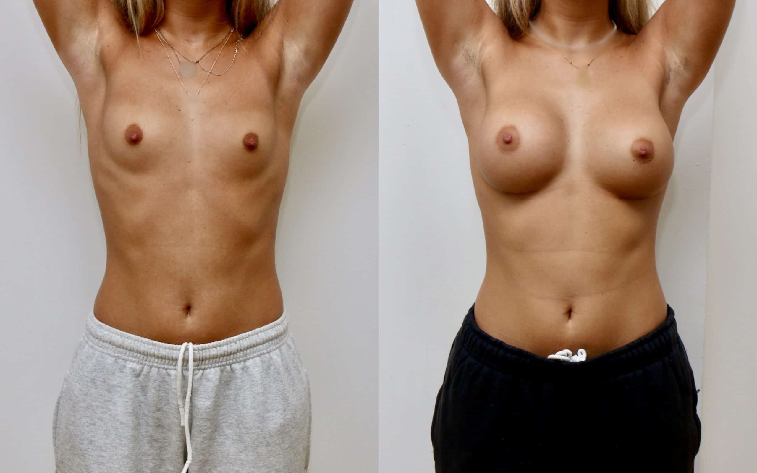 300cc breast implants below the muscle 6 months post op