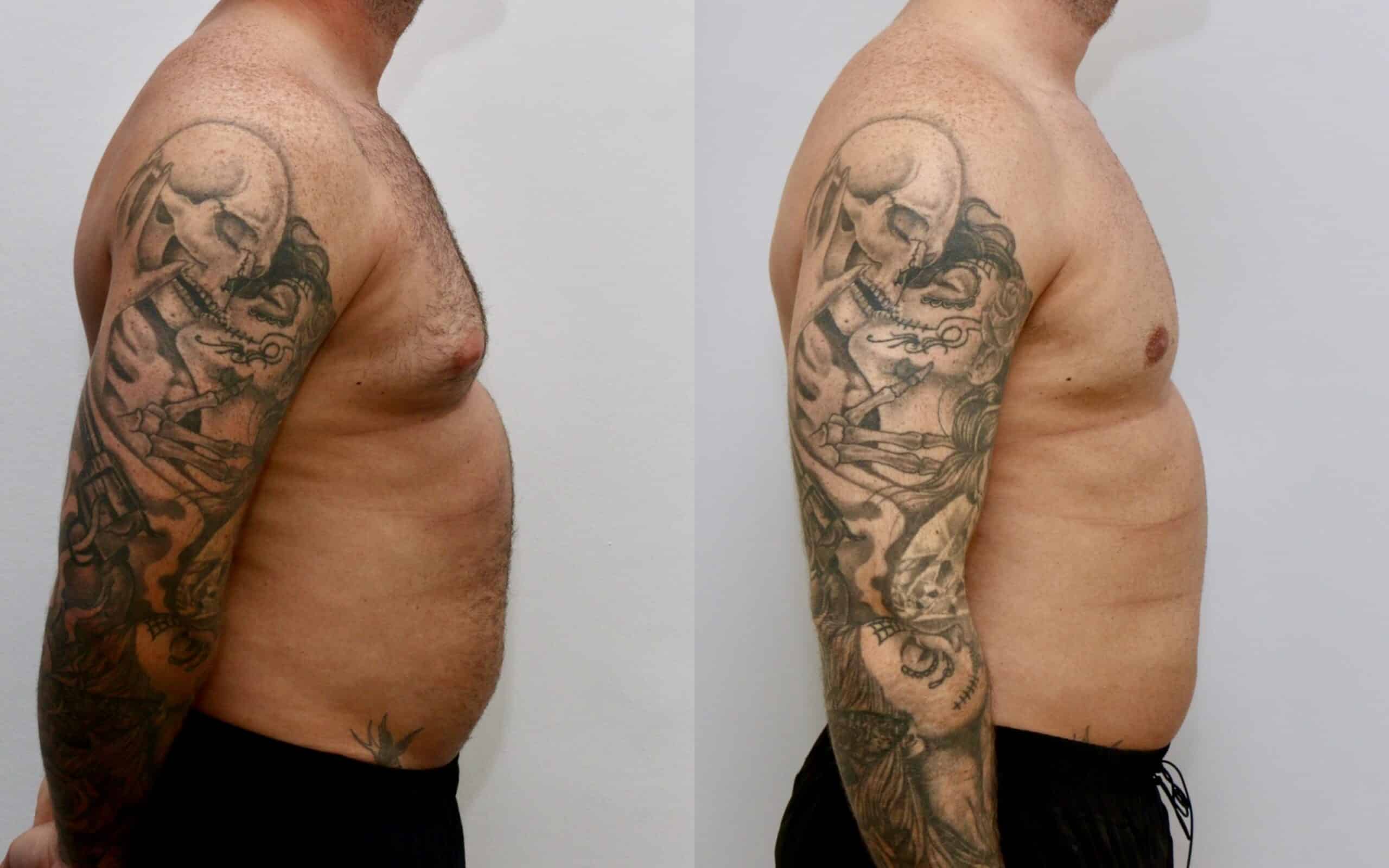 male breast reduction before and after