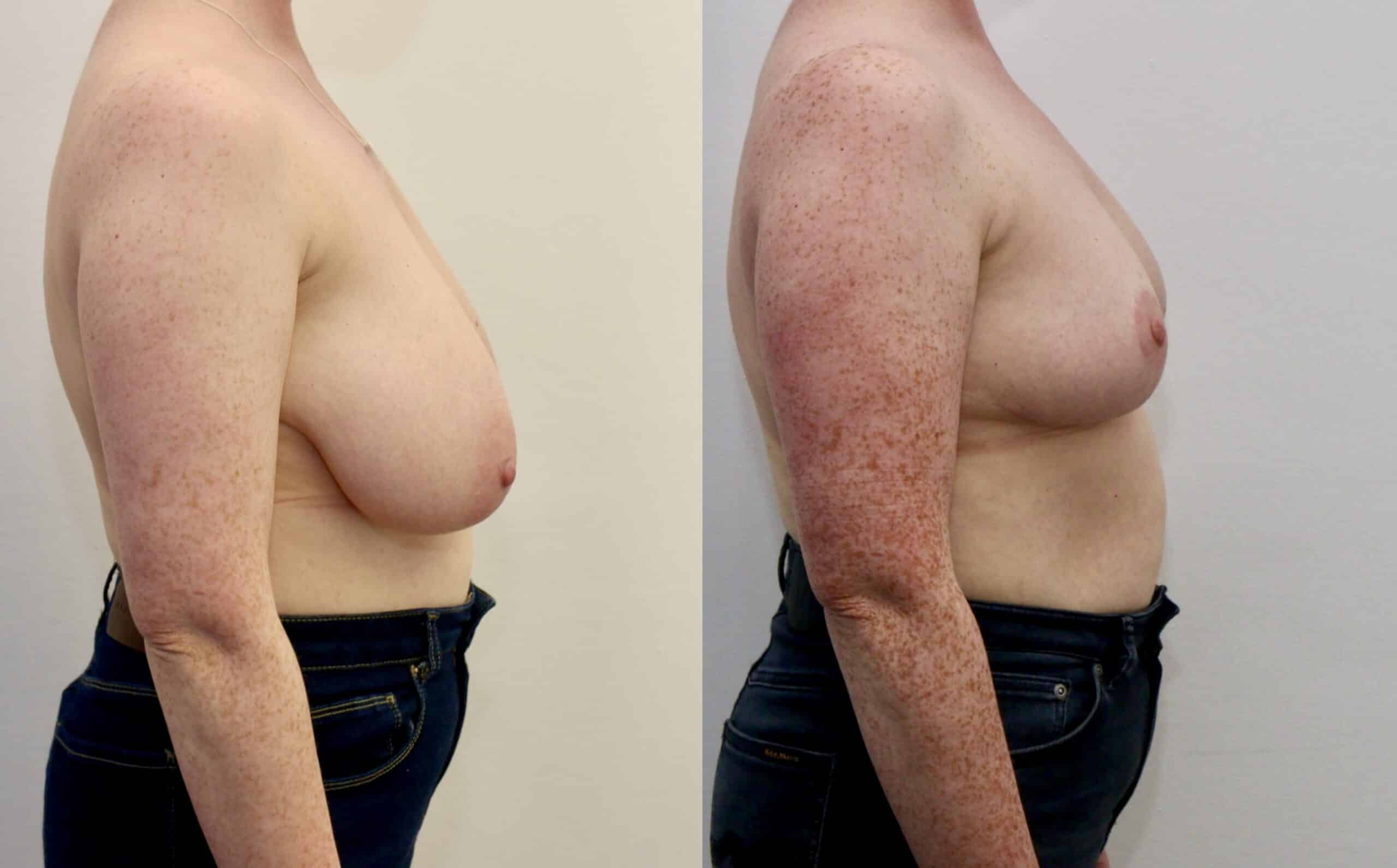 breast reduction before and after