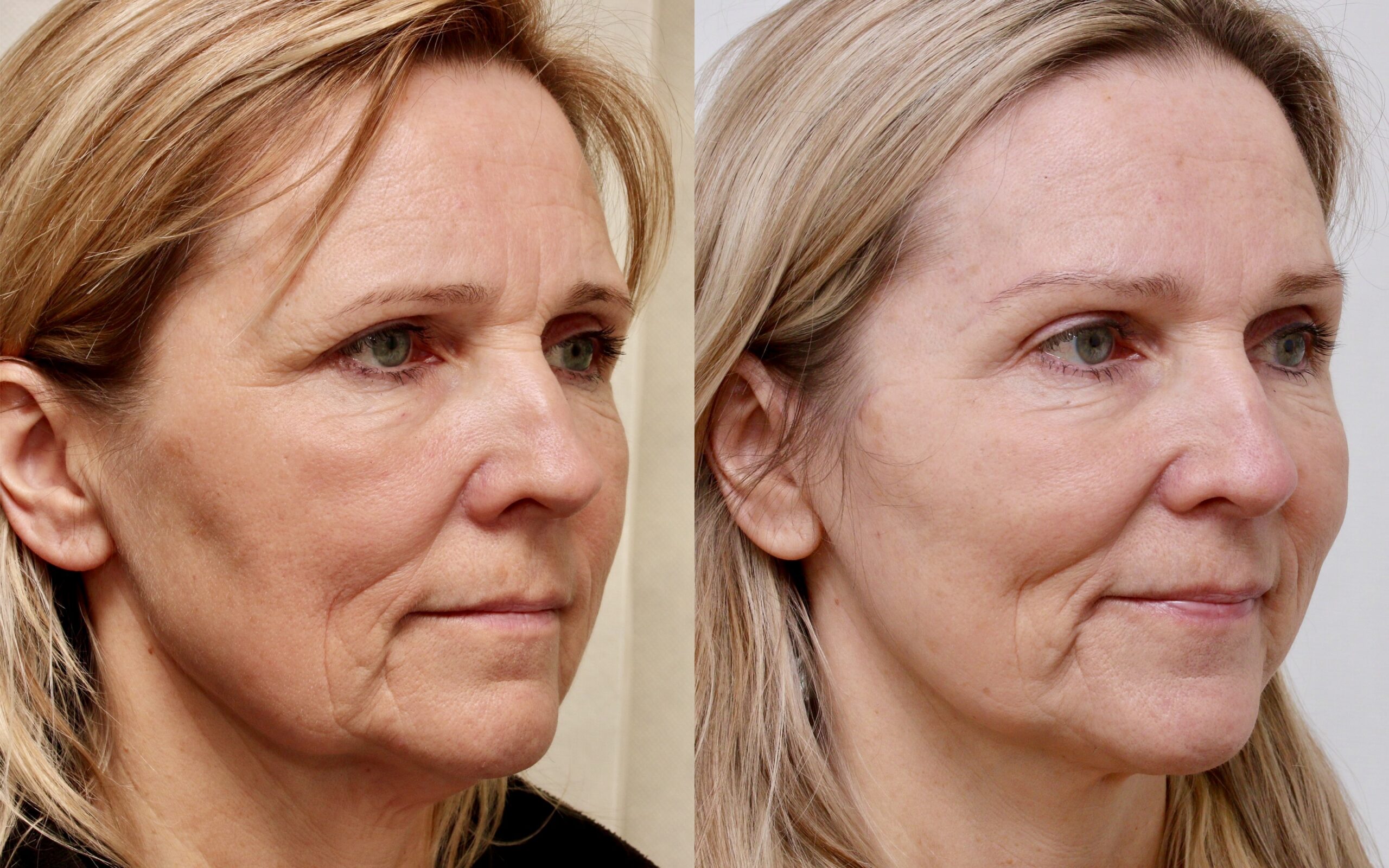 before and after image of brow lift scotland