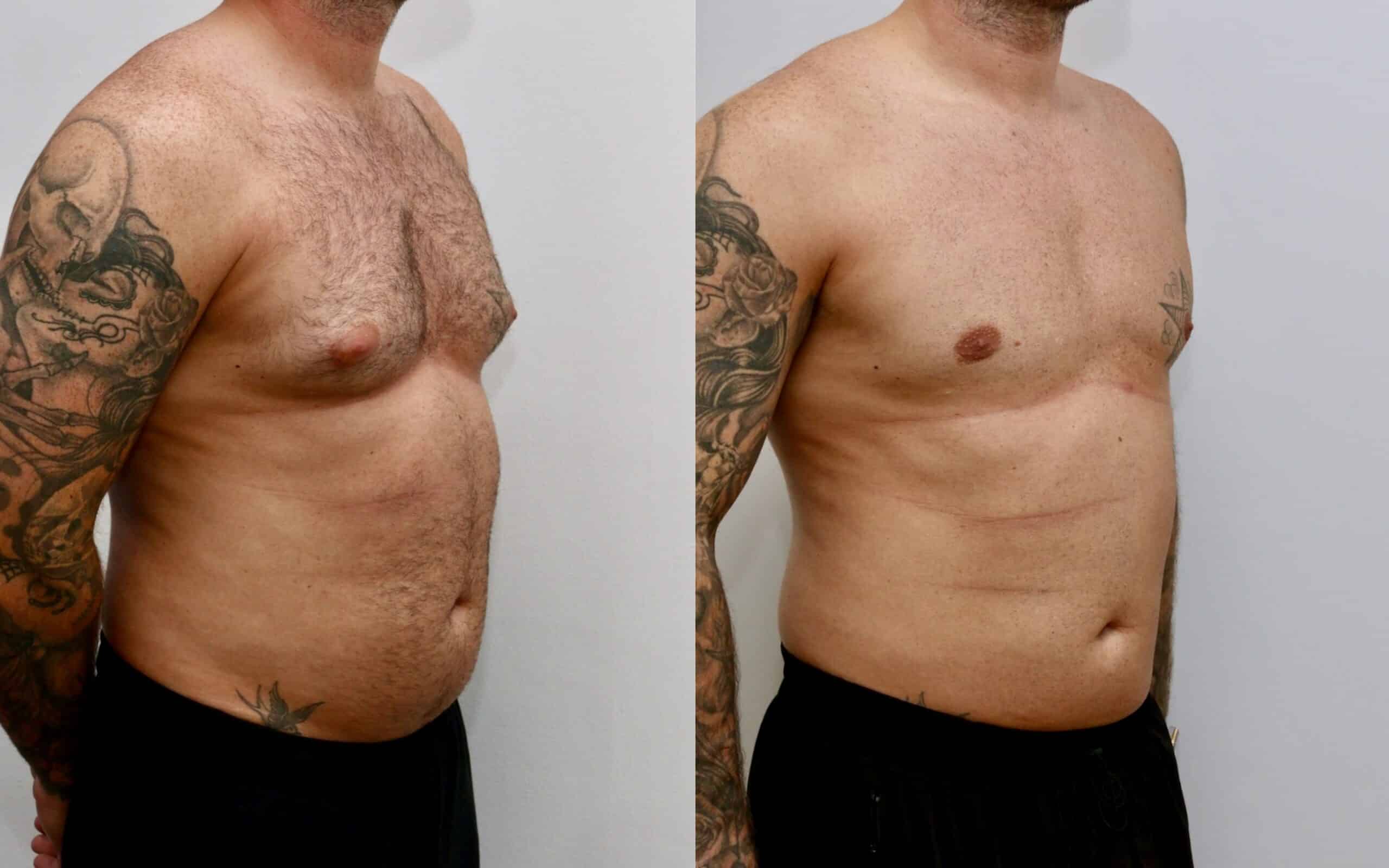 male breast reduction before and after