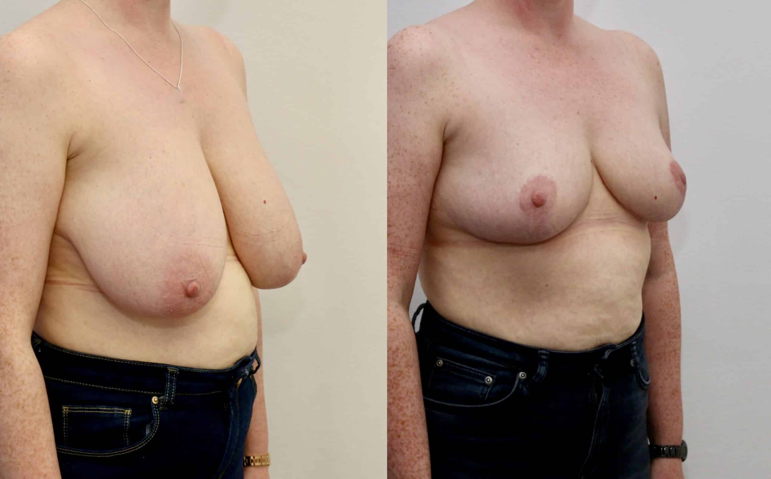 breast reduction before and after