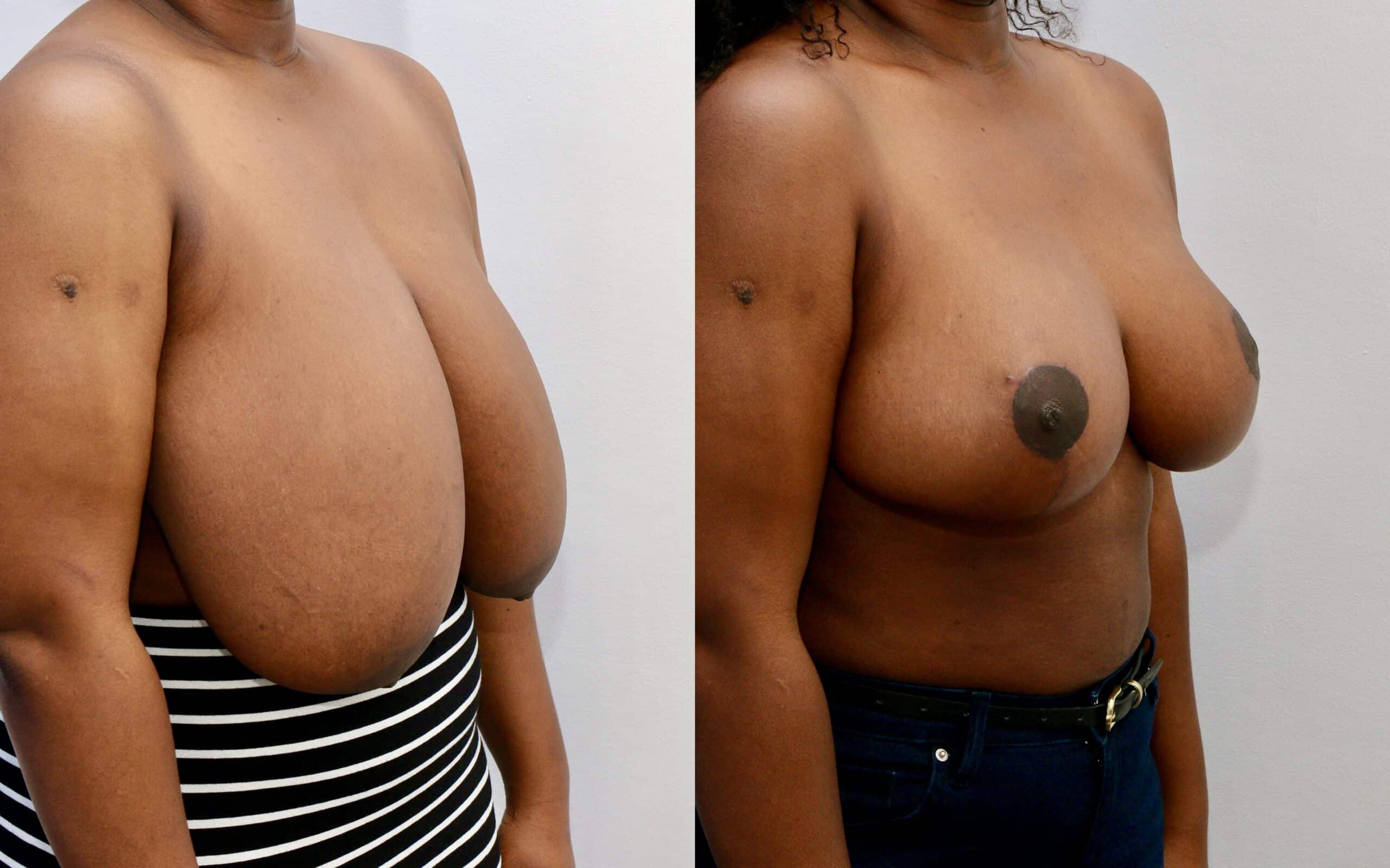 breast reduction surgery in Scotland