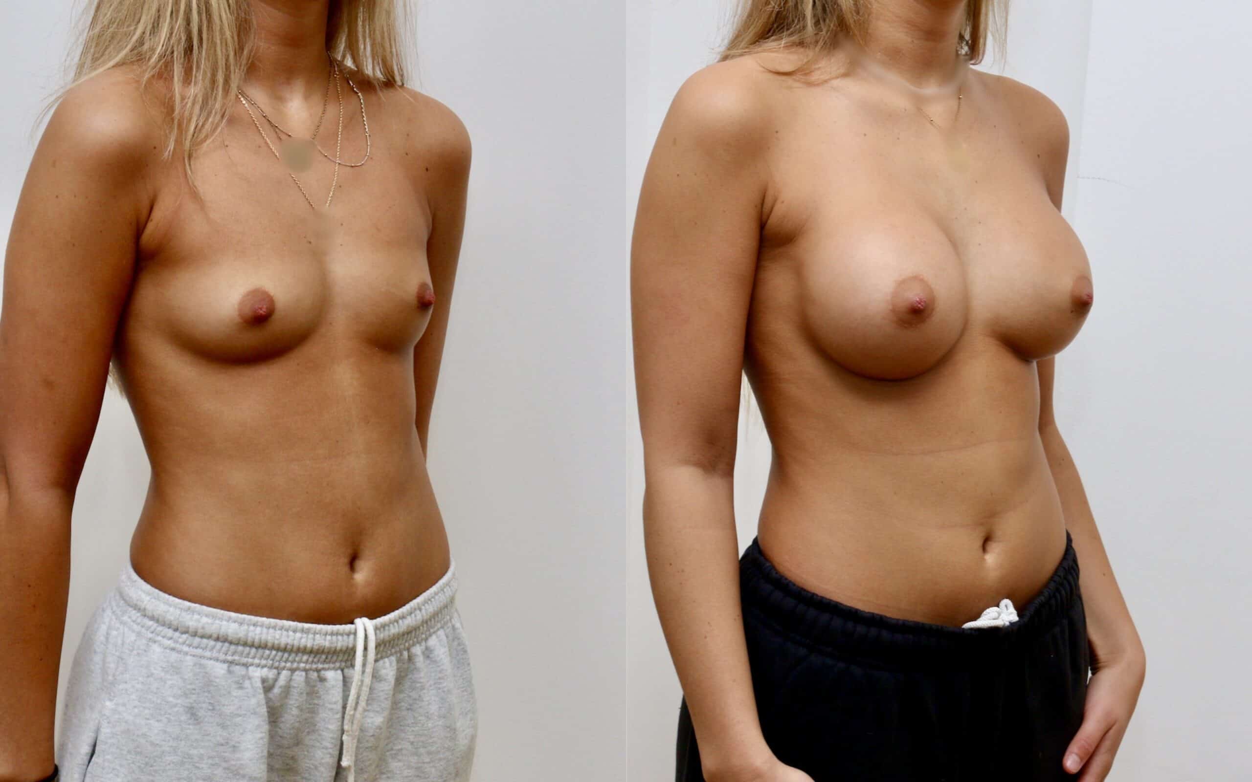 300cc breast implants below the muscle 6 months post op