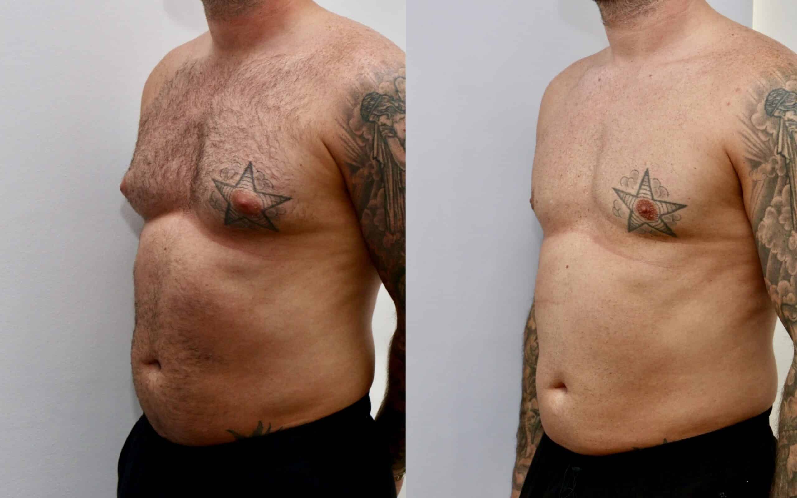 male breast reduction before and after