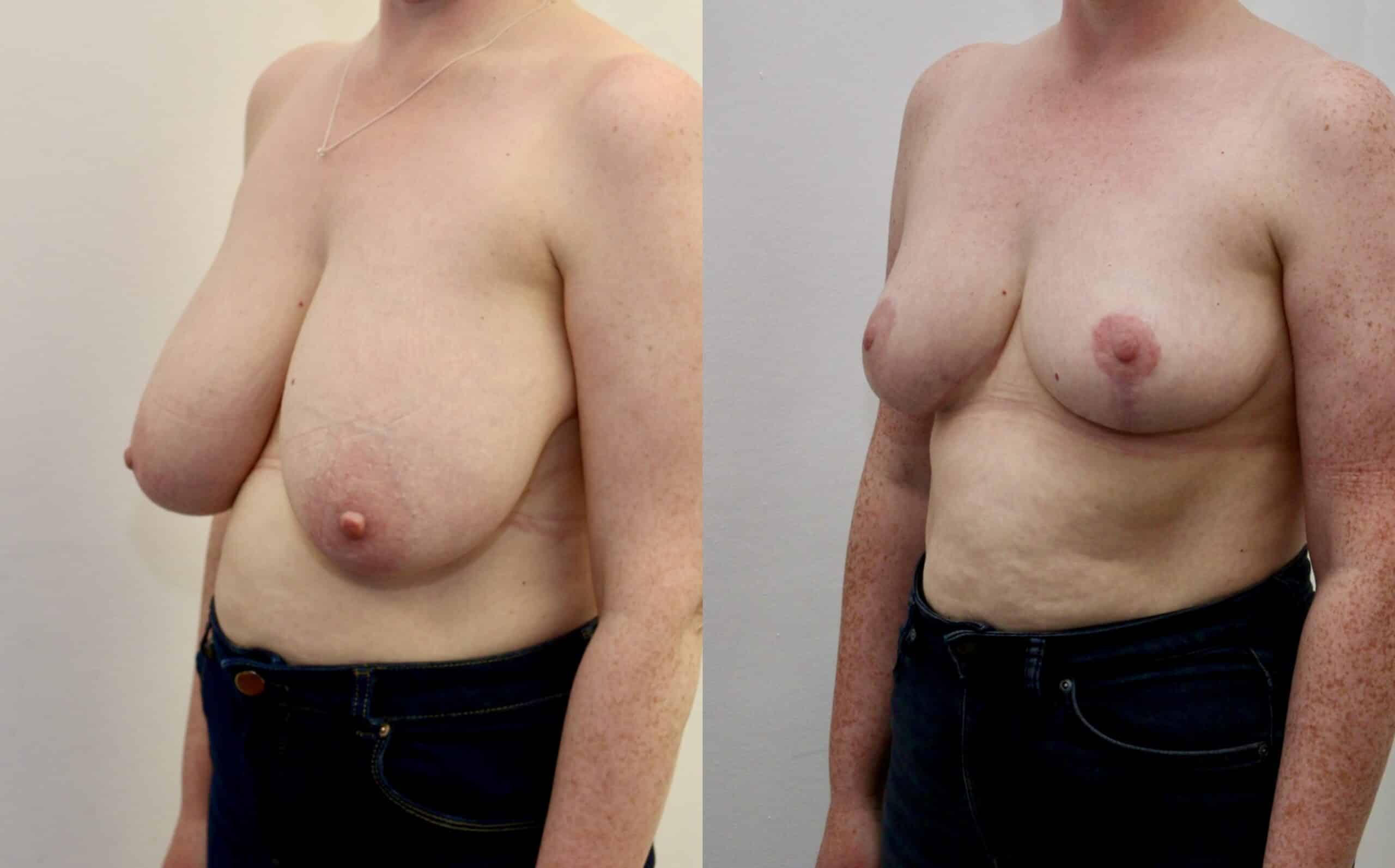 breast reduction before and after