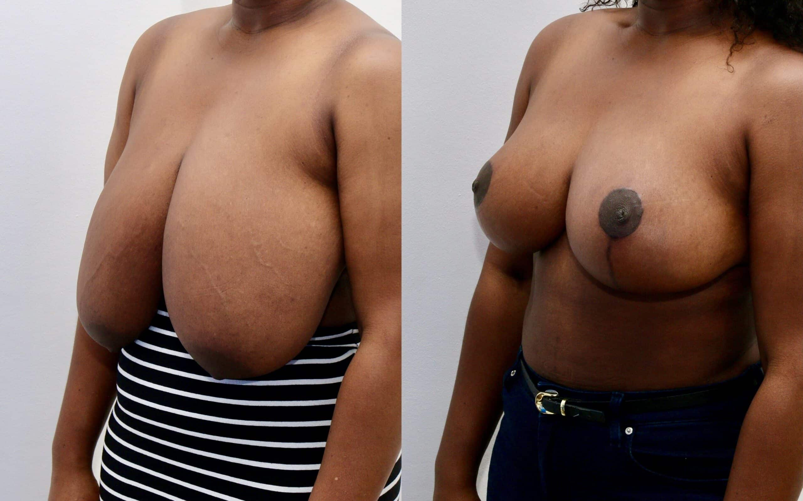 breast reduction surgery in Scotland