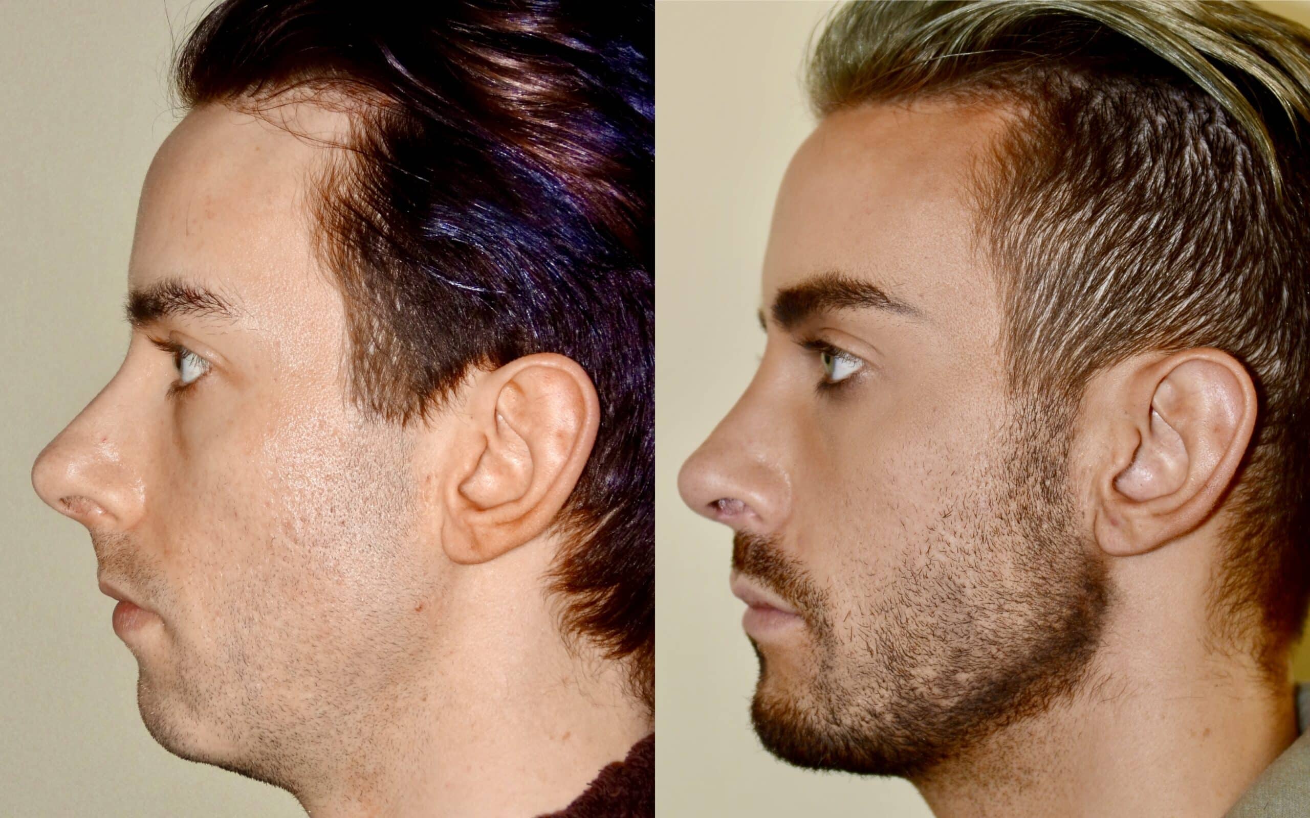 side profile view of chin implants before and after