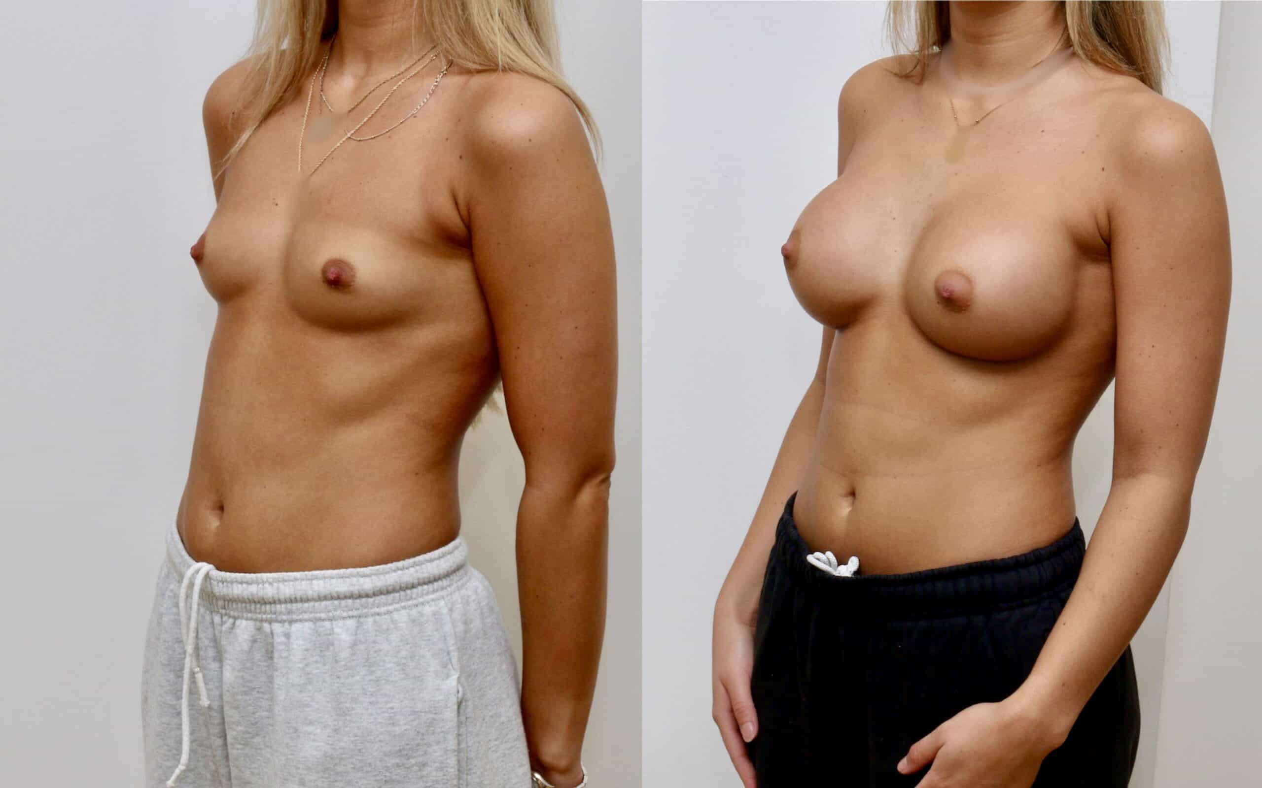 300cc breast implants below the muscle 6 months post op