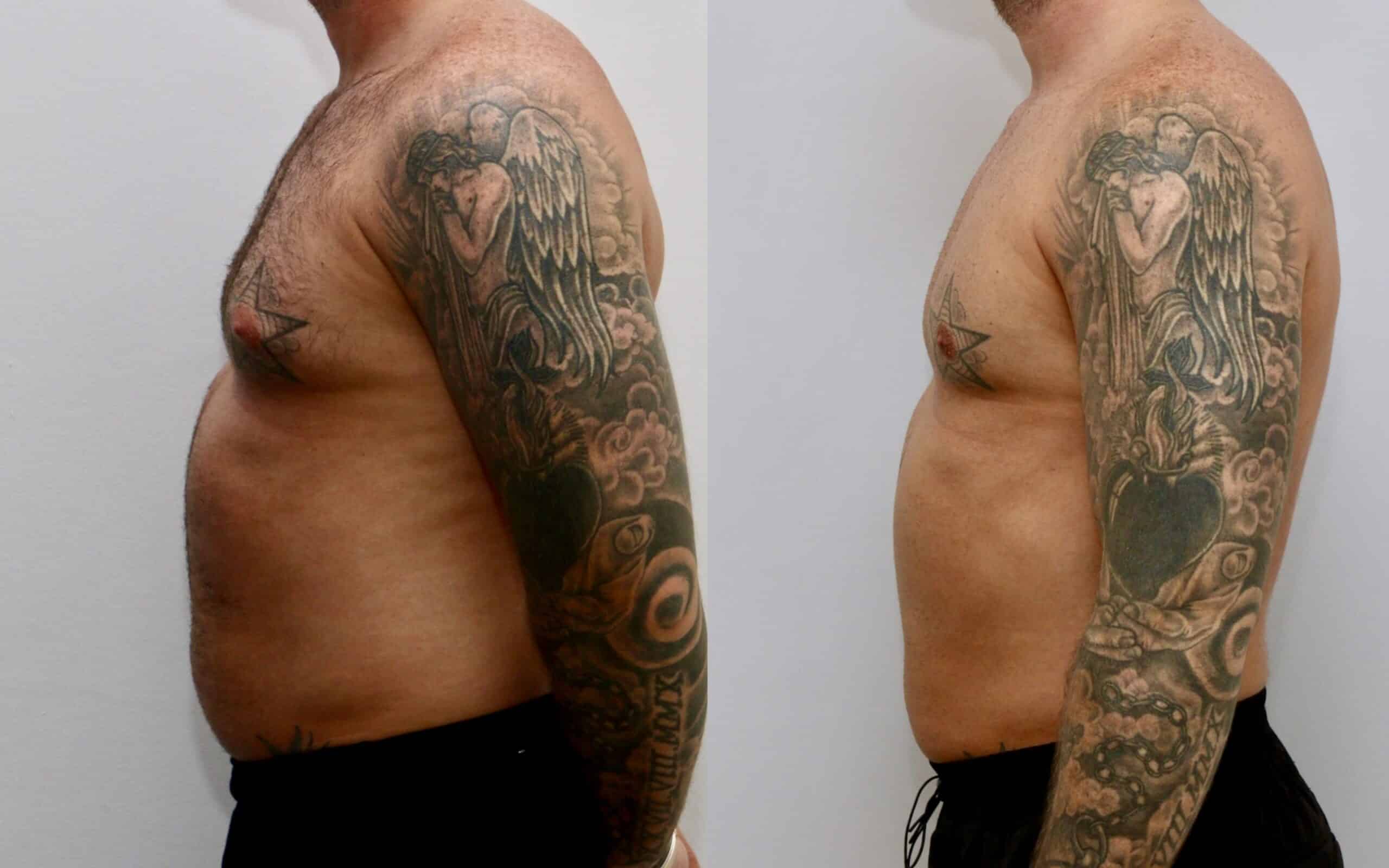 male breast reduction before and after