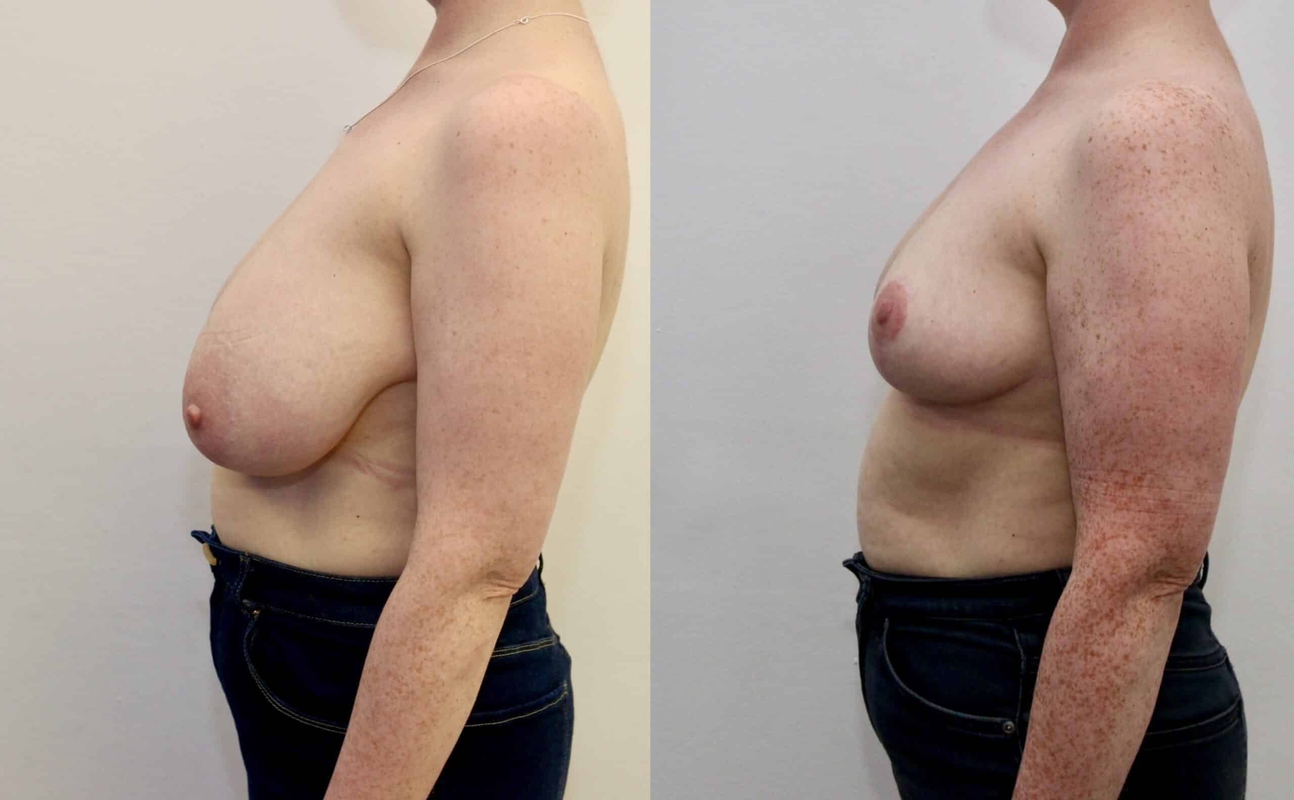 breast reduction before and after