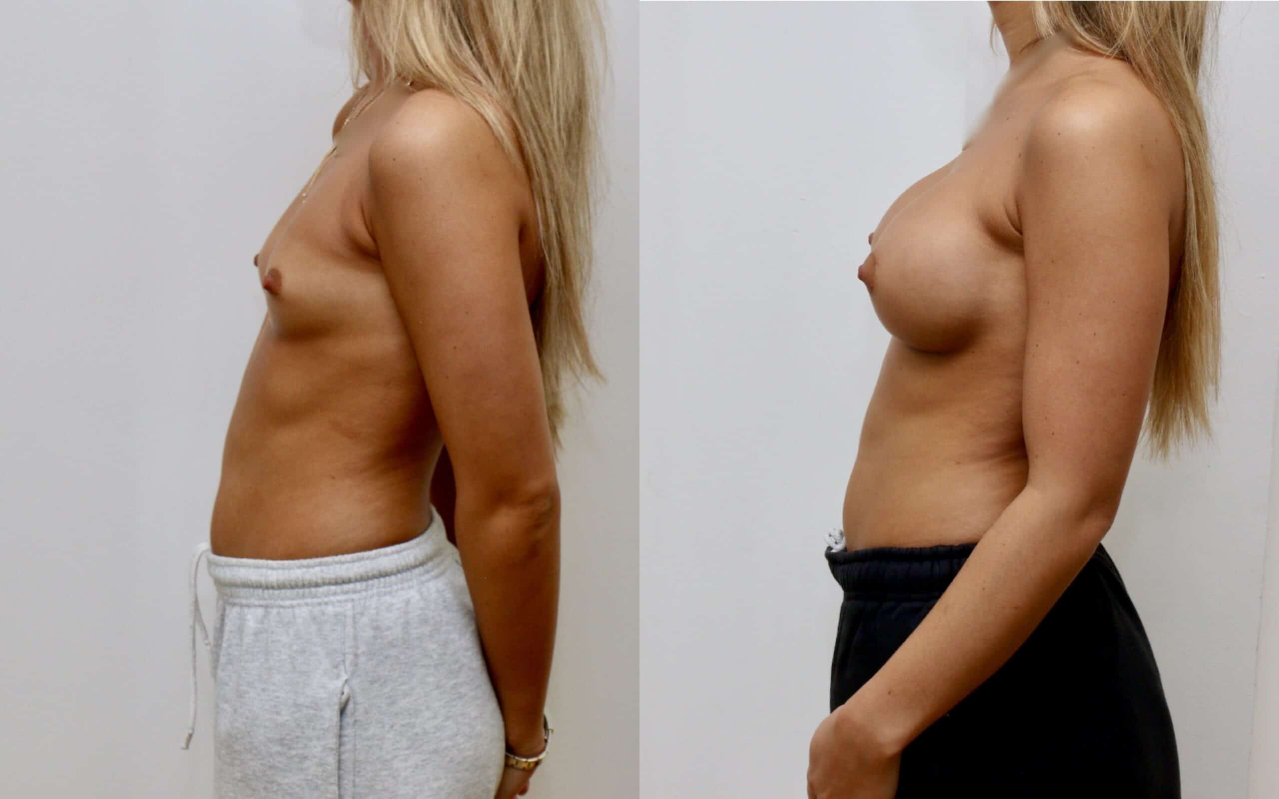 300cc breast implants below the muscle 6 months post op