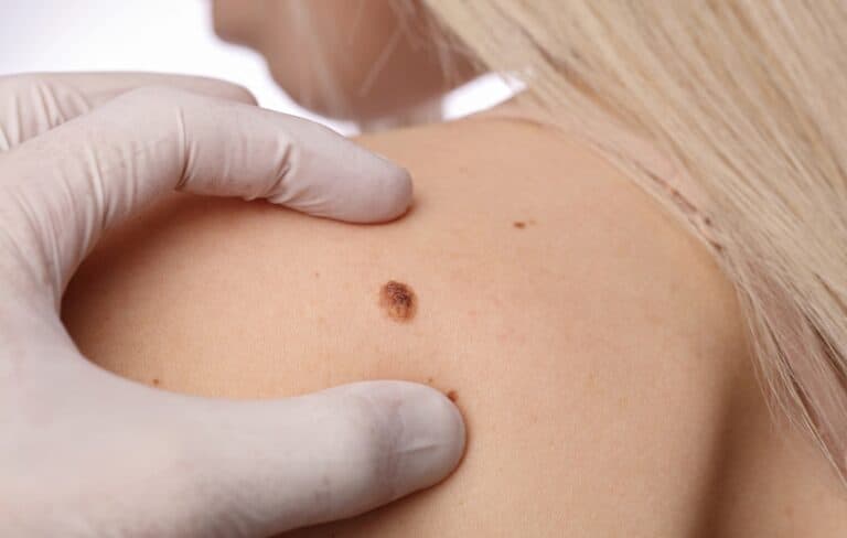 edinburgh mole clinic skin cancer removal and diagnosis