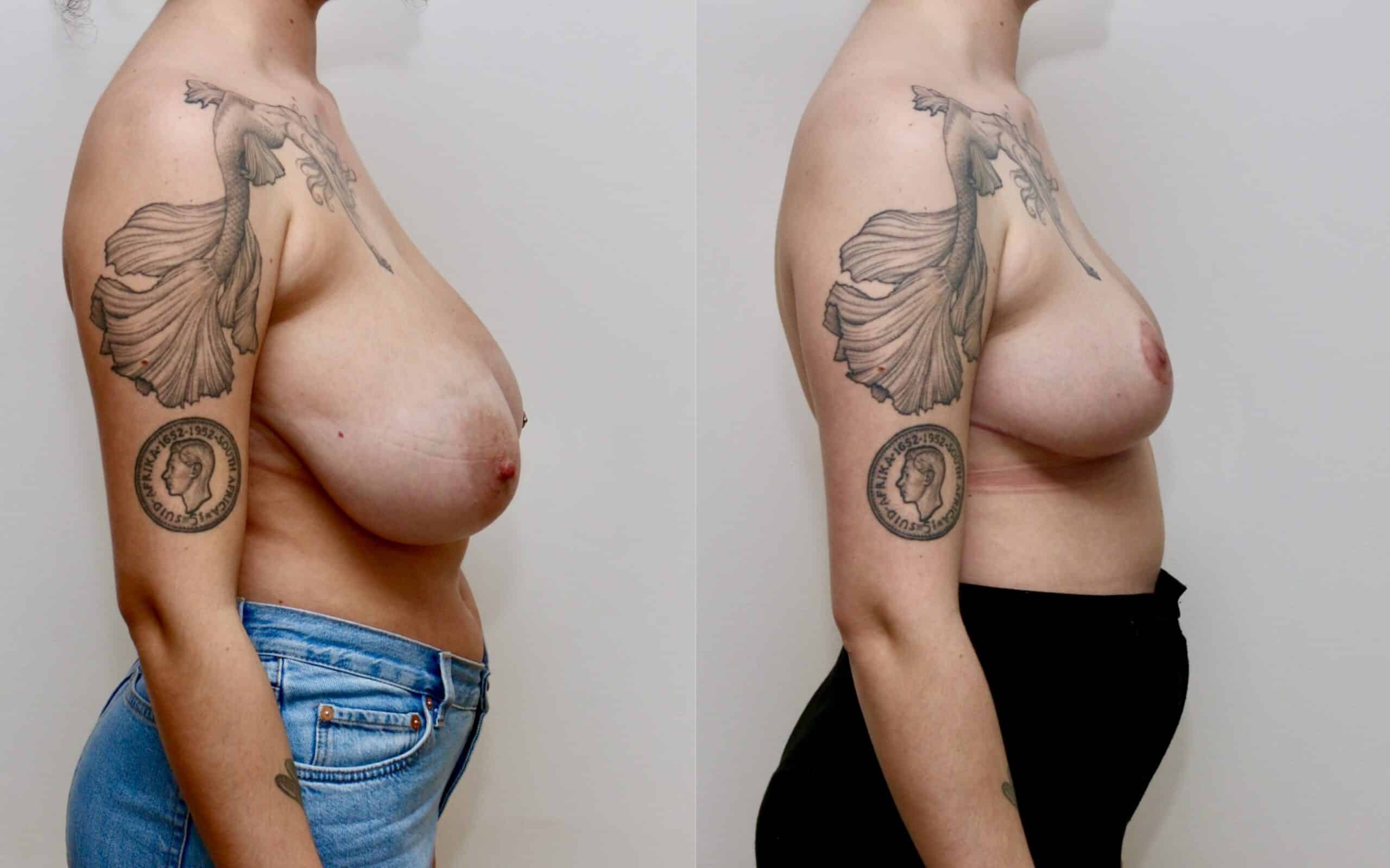 Large breast reduction in patient in early 20s