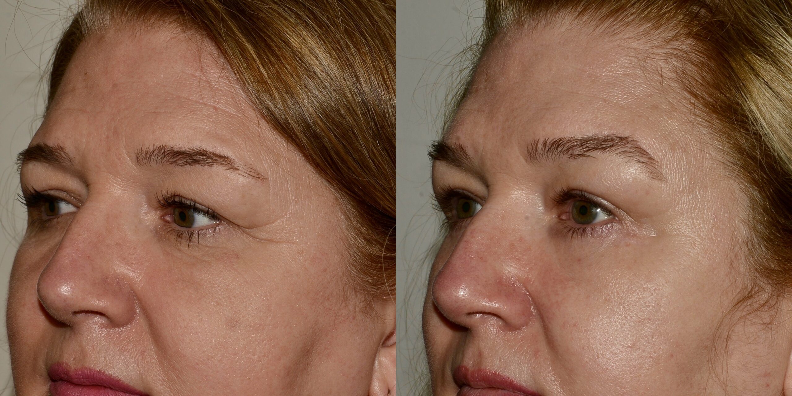 eyelid lift