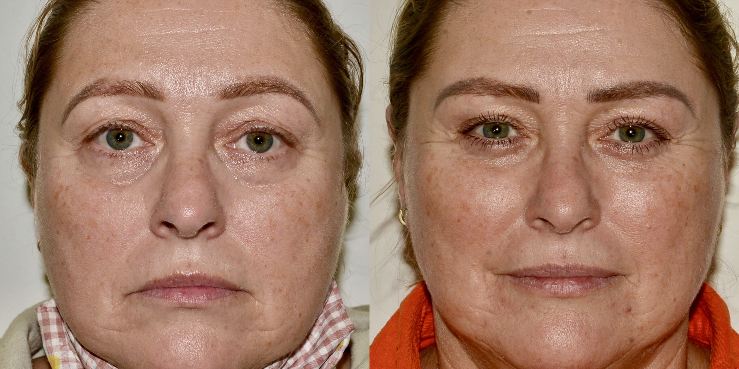 Direct brow with eyelid surgery