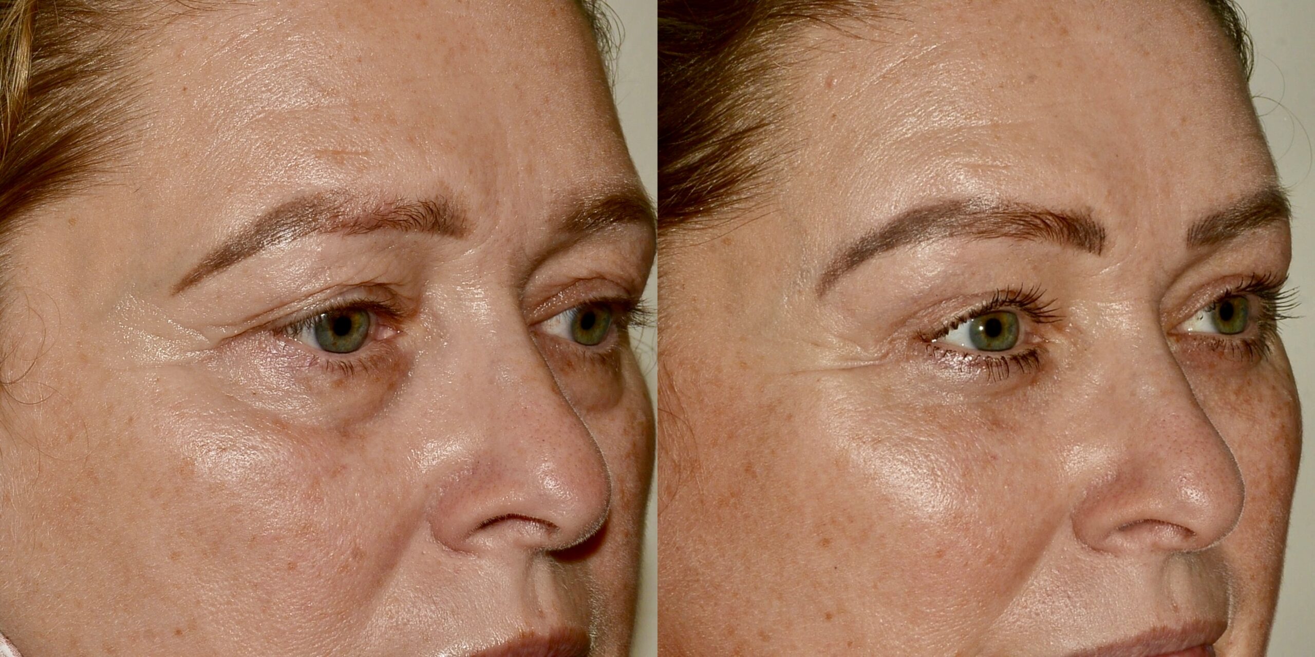 direct brow lift scotland