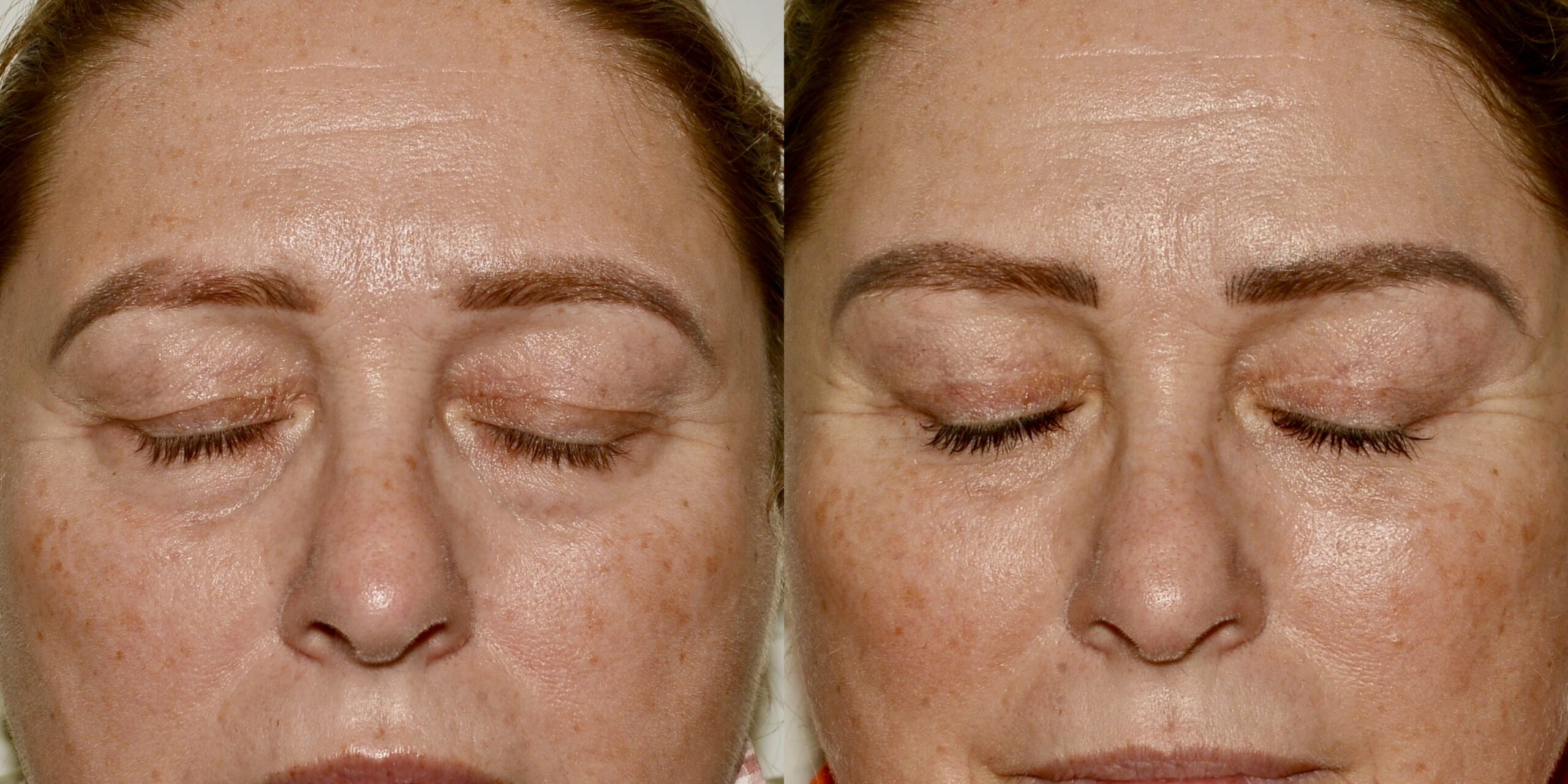 Direct brow with eyelid surgery