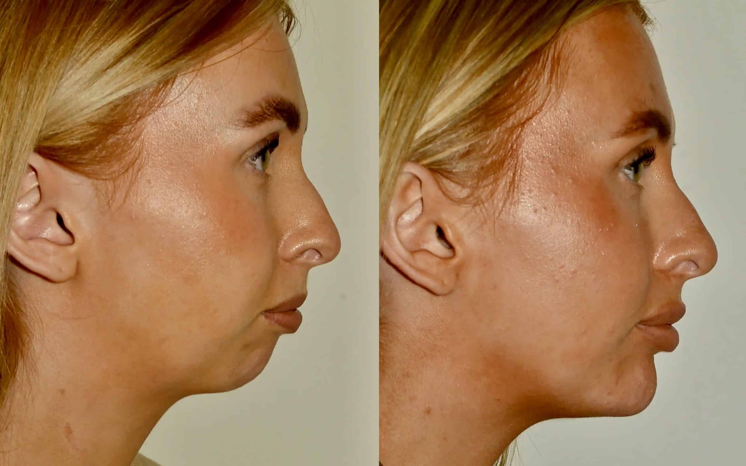 chin implants scotland