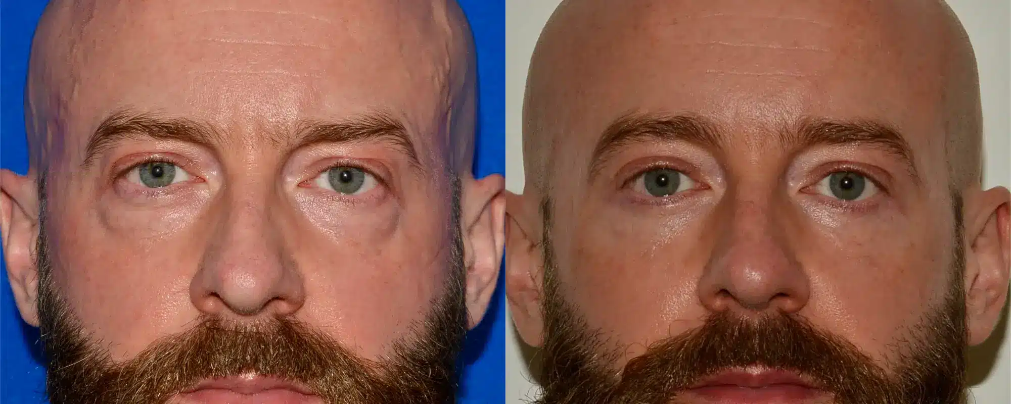 eye bag removal scotland