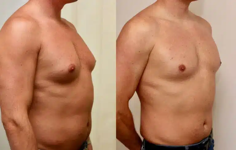 gynecomastia aftercare before and after photos
