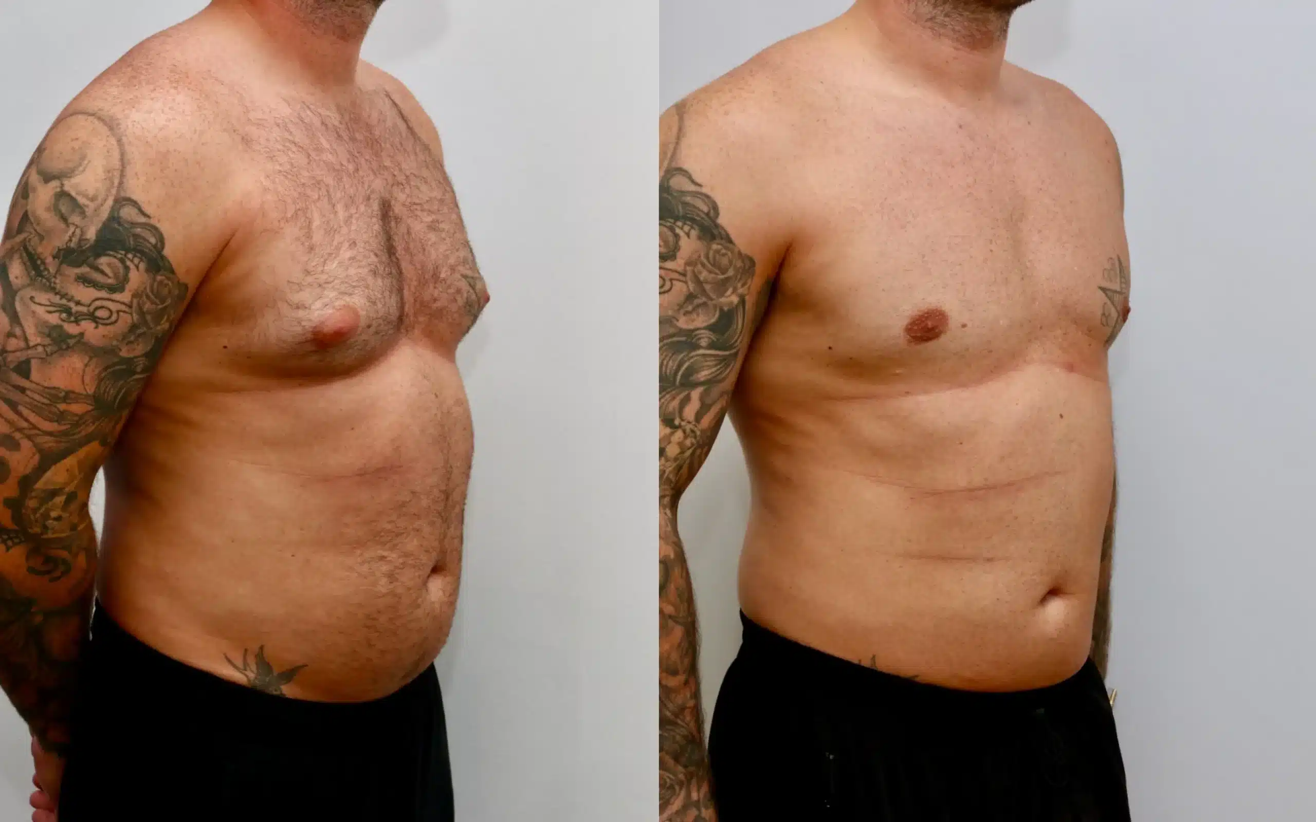 male breast reduction edinburgh