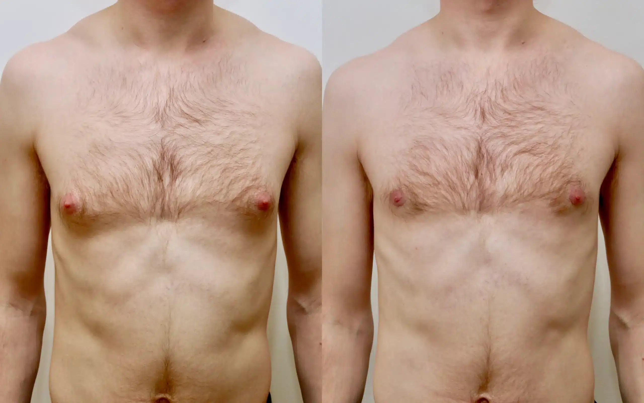 gyno surgery before and after under local anaesthesia