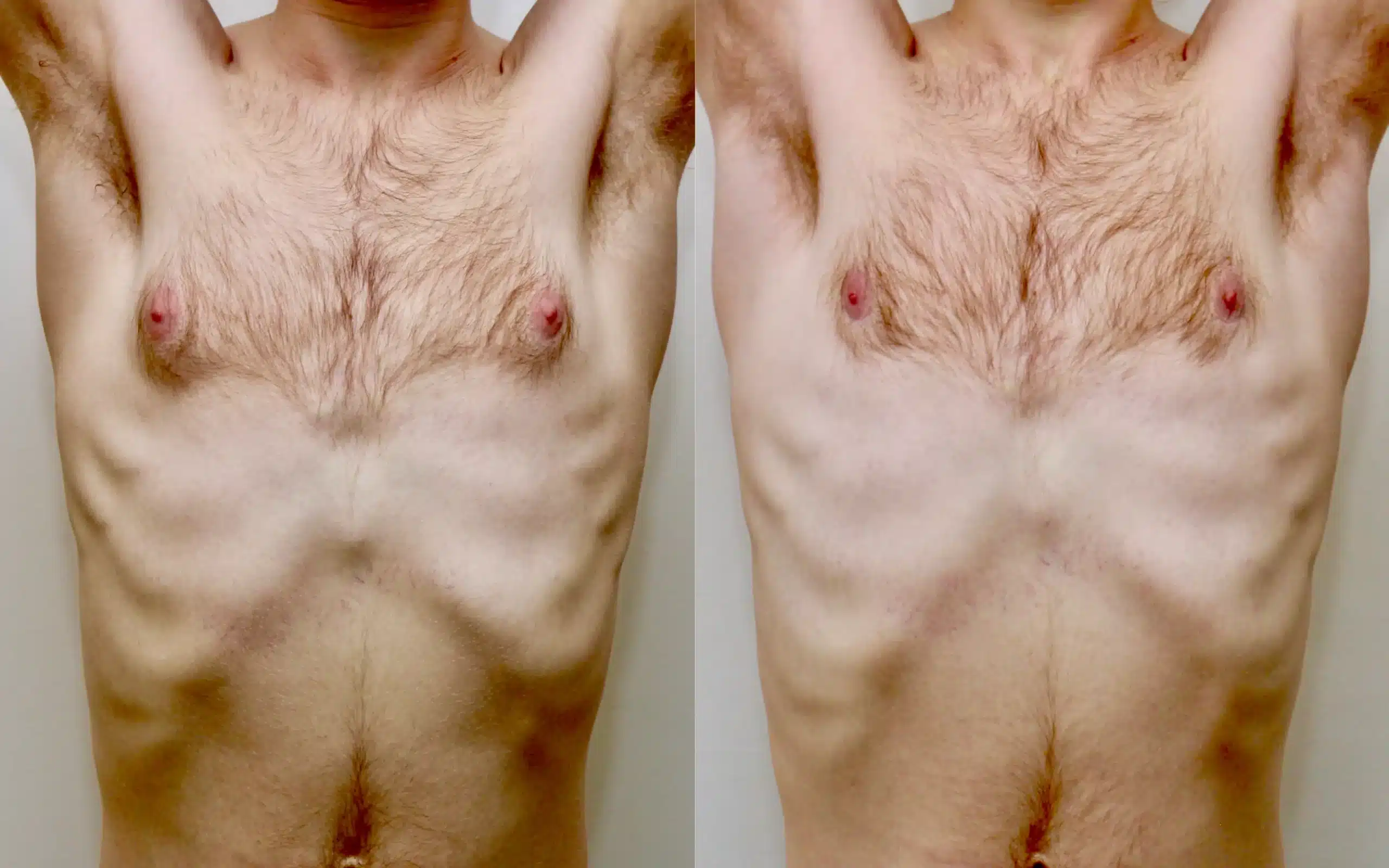 gyno surgery before and after under local anaesthesia